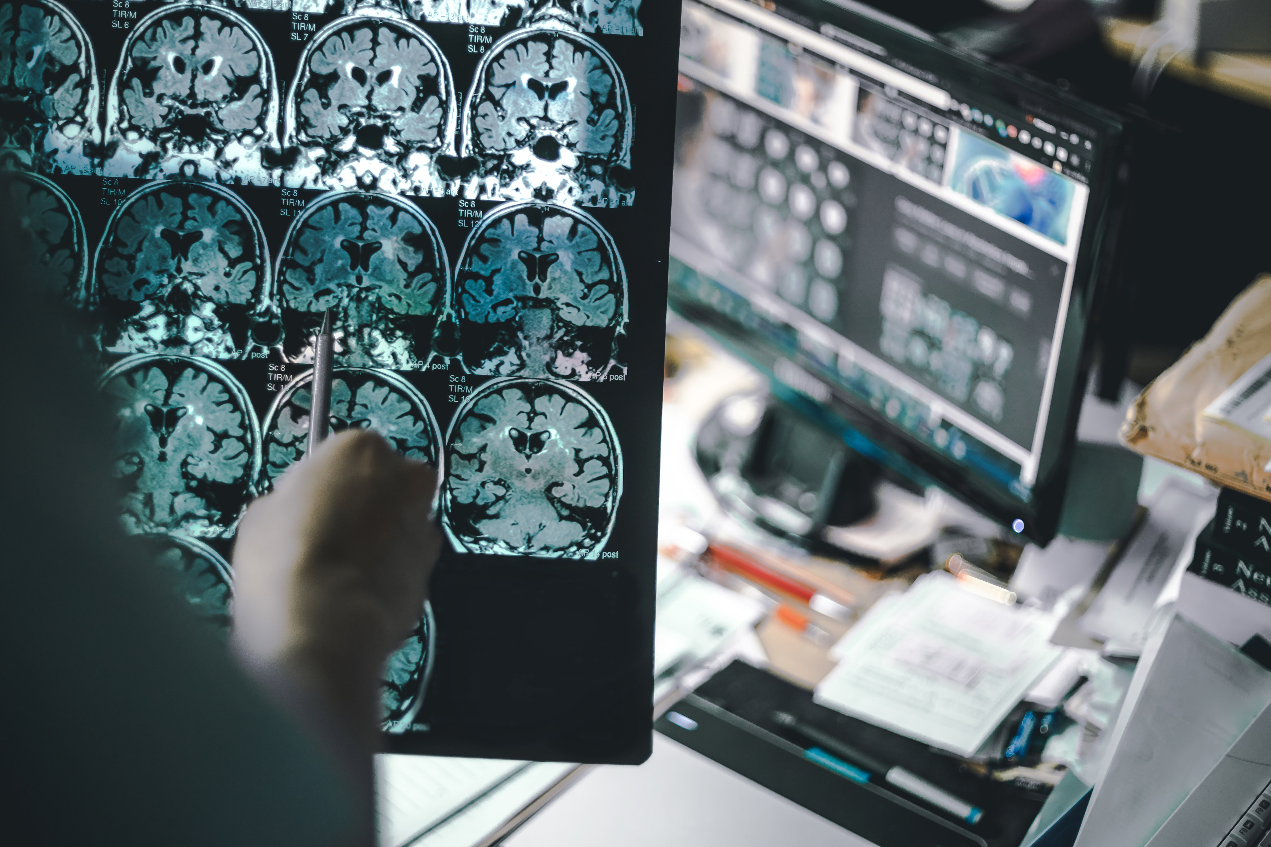 An MRI scan shows the progress of Alzheimer’s disease. Photo: Shutterstock