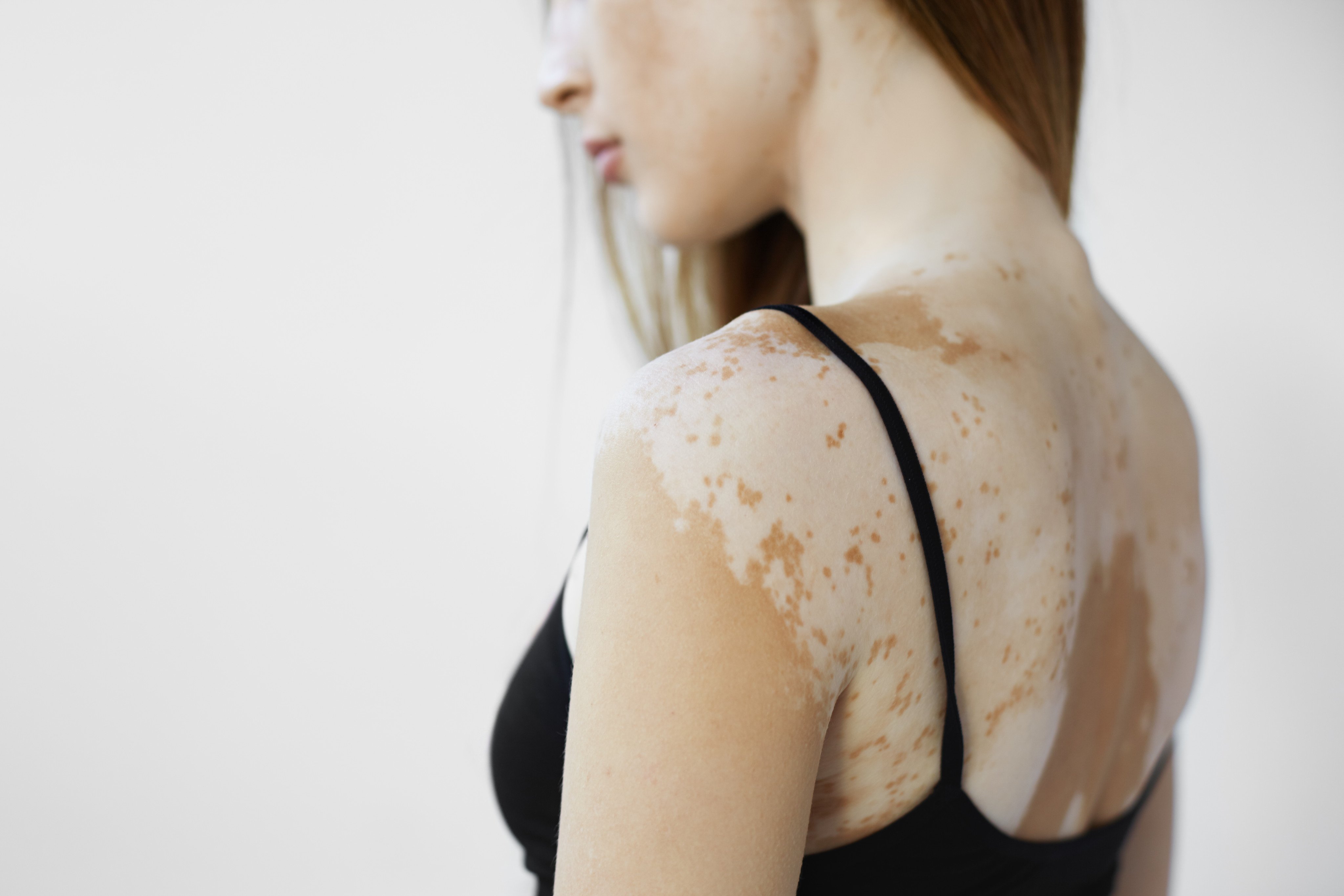 Vitiligo – the development of pale white patches on the skin caused by a lack of melanin – can strip a sufferer of self-confidence and stop them taking part in social events. Photo: Shutterstock