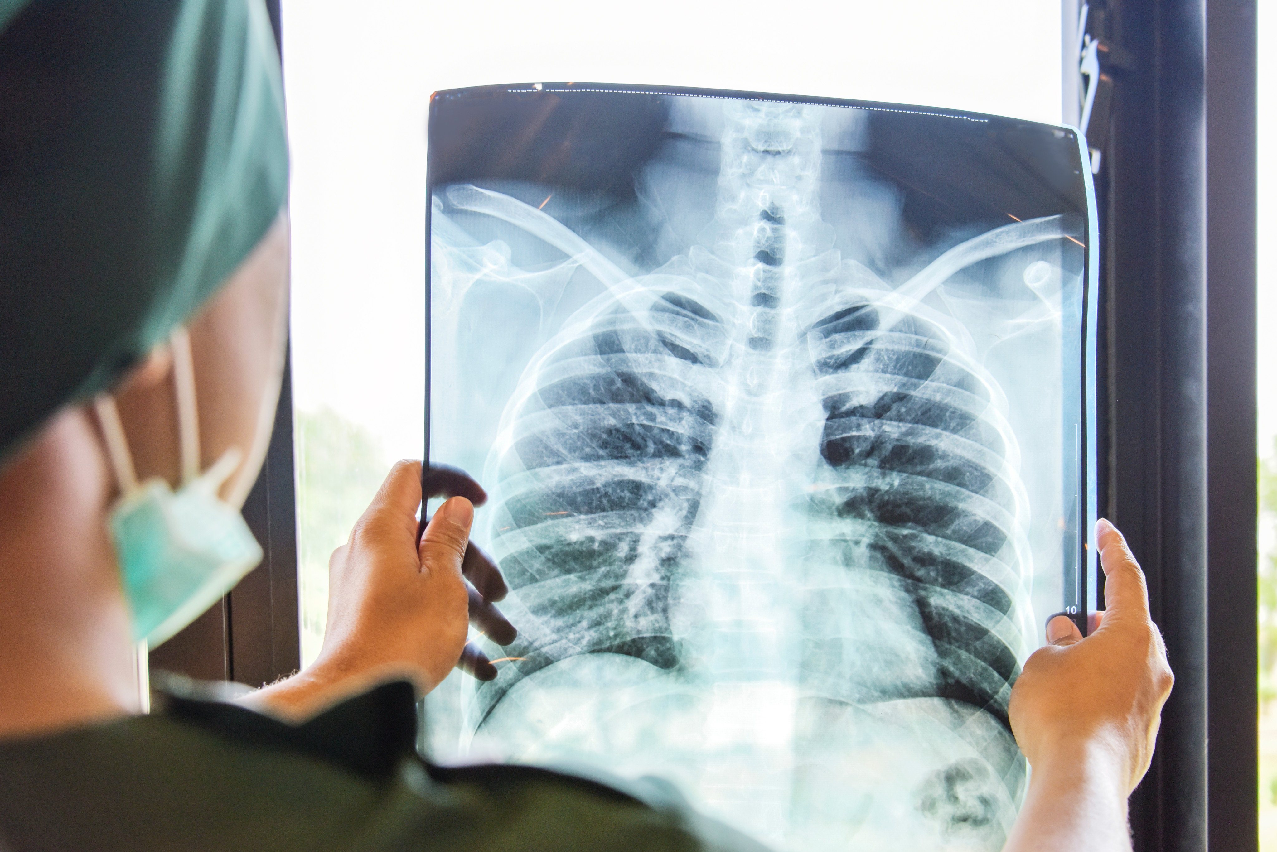 In a Chinese study, 17 patients with varying stages of COPD who received the team’s therapy had no serious adverse side effects and the team did not observe signs of tumour formation in the patients six months after transplant. Photo: Shutterstock