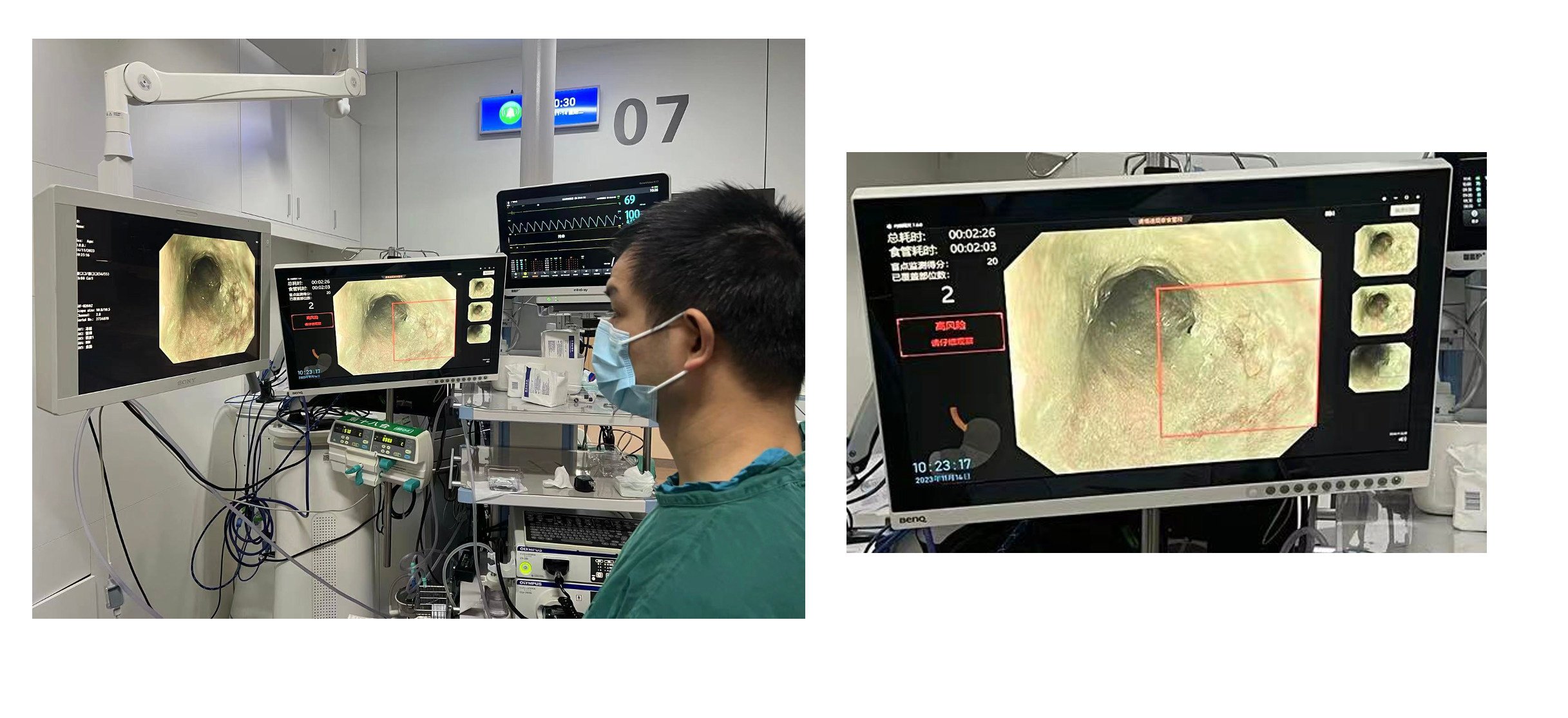 A doctor views an AI-aided map of oesophageal lesions during a trial. Photo: Mao Xinli