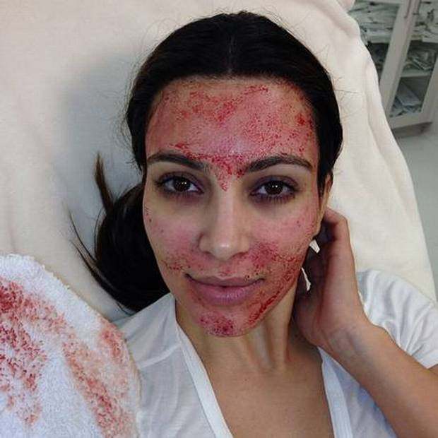 Kim Kardashian after getting a vampire facelift. Photo: X