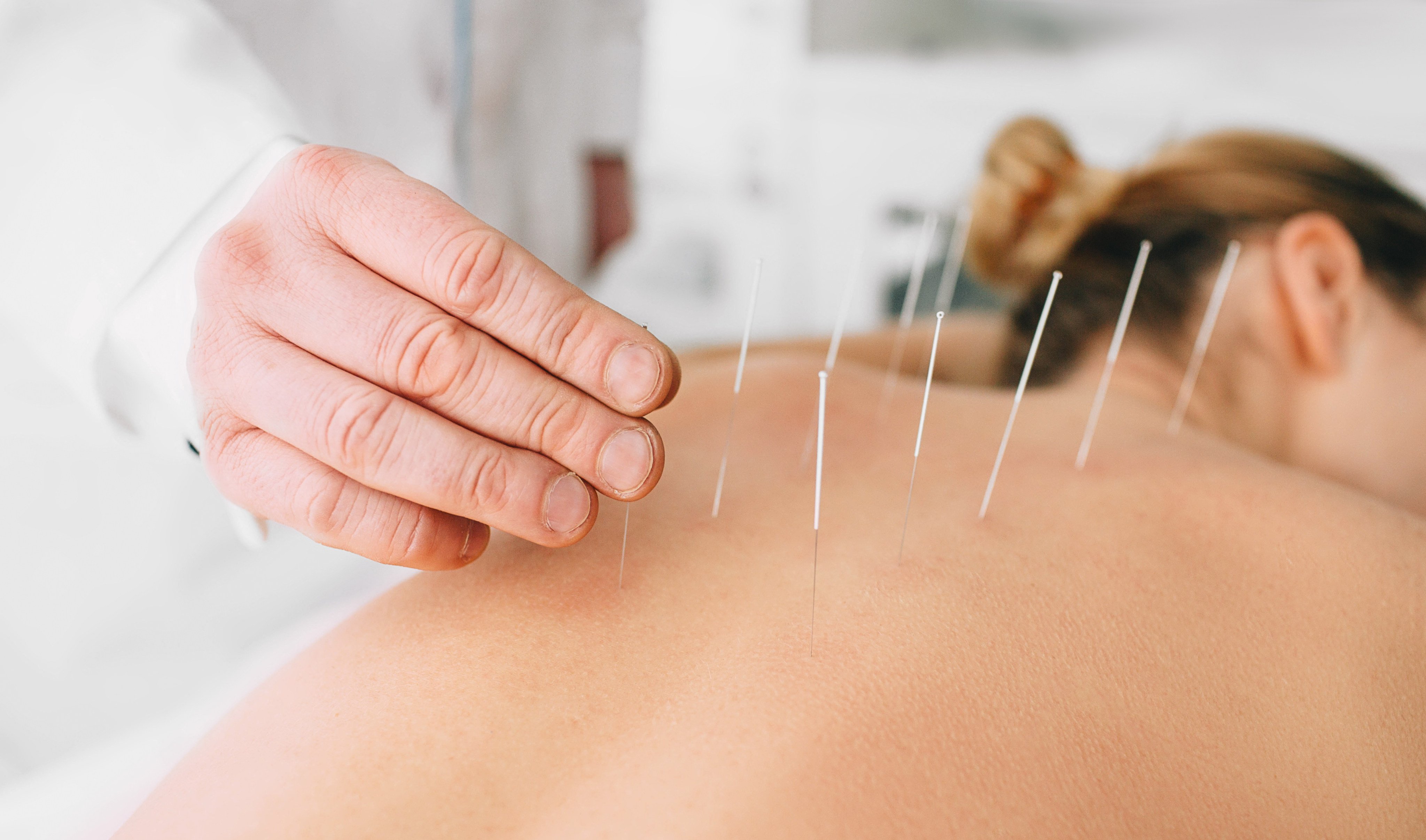 Acupuncture is the most common form of traditional Chinese medicine in use at Hong Kong hospitals. The city is taking steps to more fully integrate TCM into its healthcare system, but there are some challenges to overcome. Photo: Shutterstock