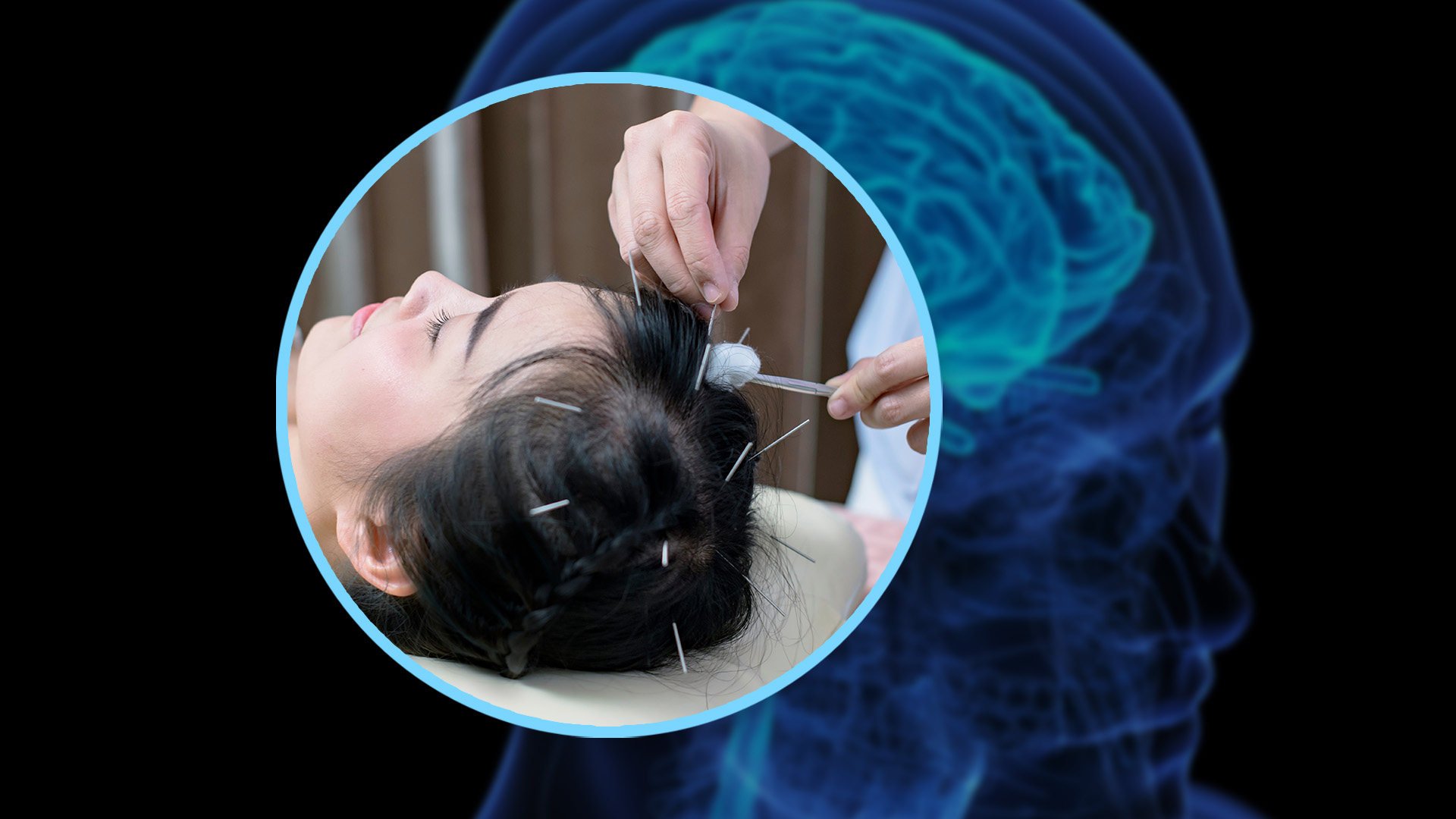 A clinic in China has claimed that it can boost the IQ of people by performing acupuncture on their heads. Photo: SCMP composite/Shutterstock