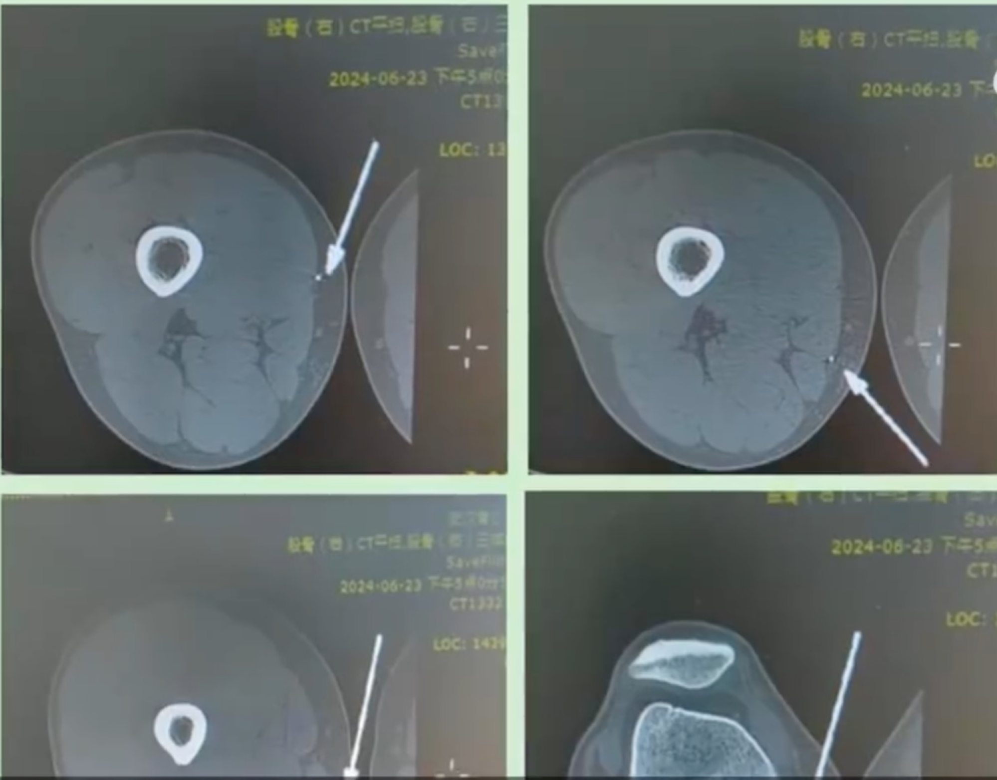 The full extent of the damage to his leg was revealed when Jiang was X-rayed at hospital. Photo: Weibo