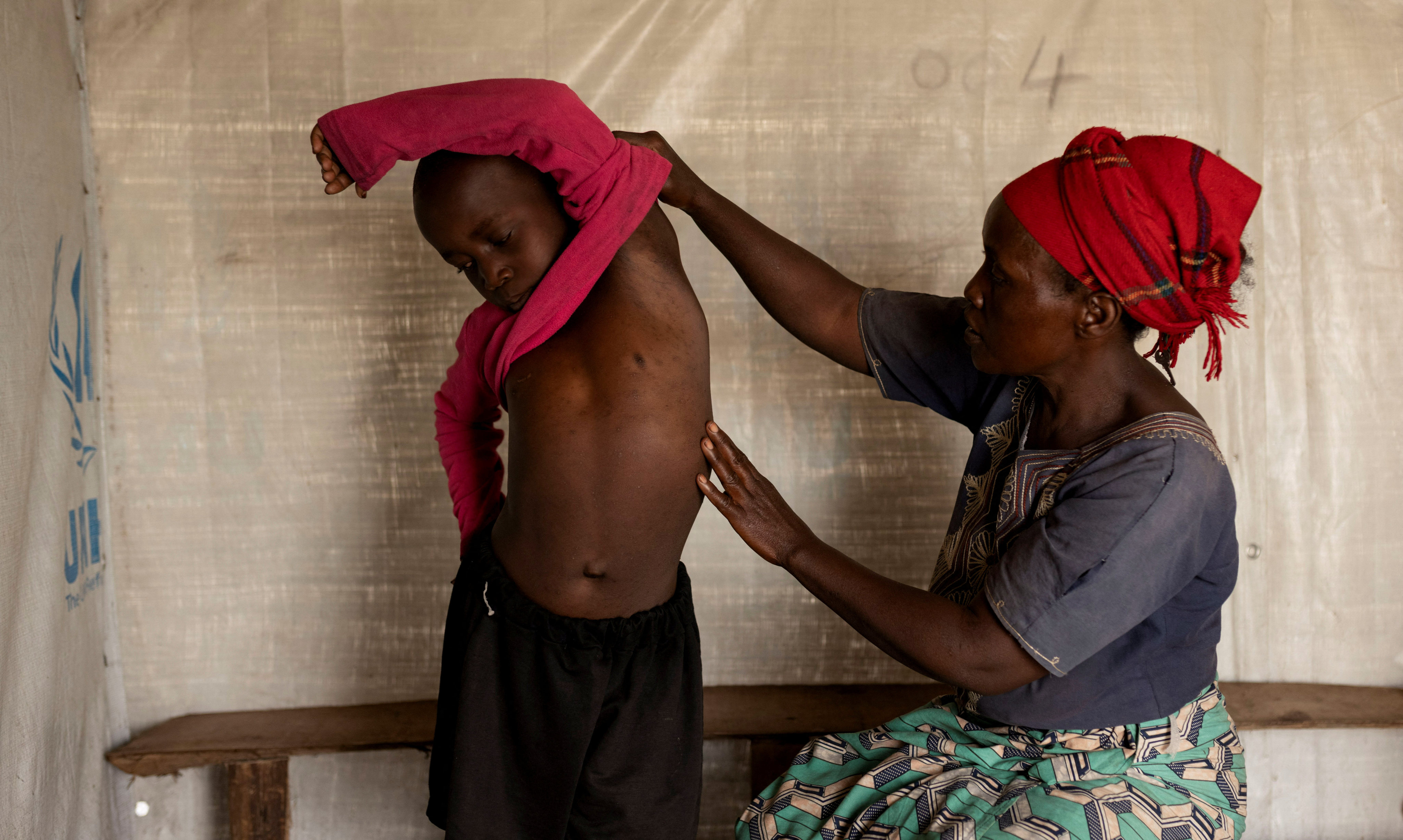Fideline Kiza Kasao checks the progress of her son Kito Balume after his recovery from mpox outside their shelter at the Muja displaced persons camp in Nyiragongo territory near Goma, North Kivu province in the Democratic Republic of the Congo in July. Photo: Reuters