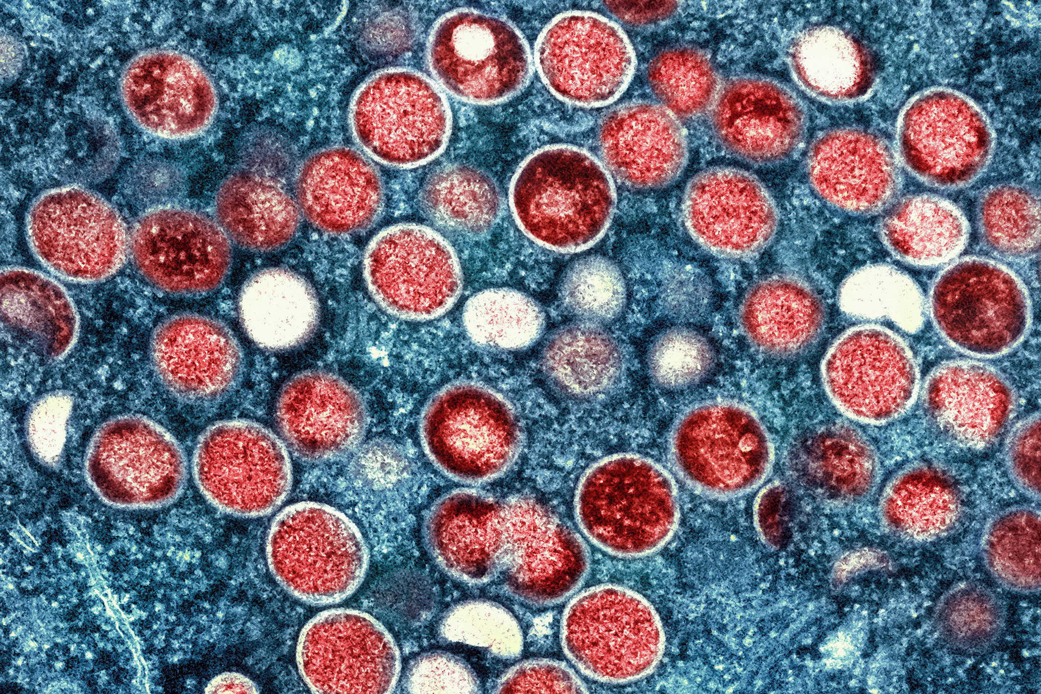 A colorised electron microscope image shows mpox particles in red found within an infected cell, shown as blue. Photo: AP