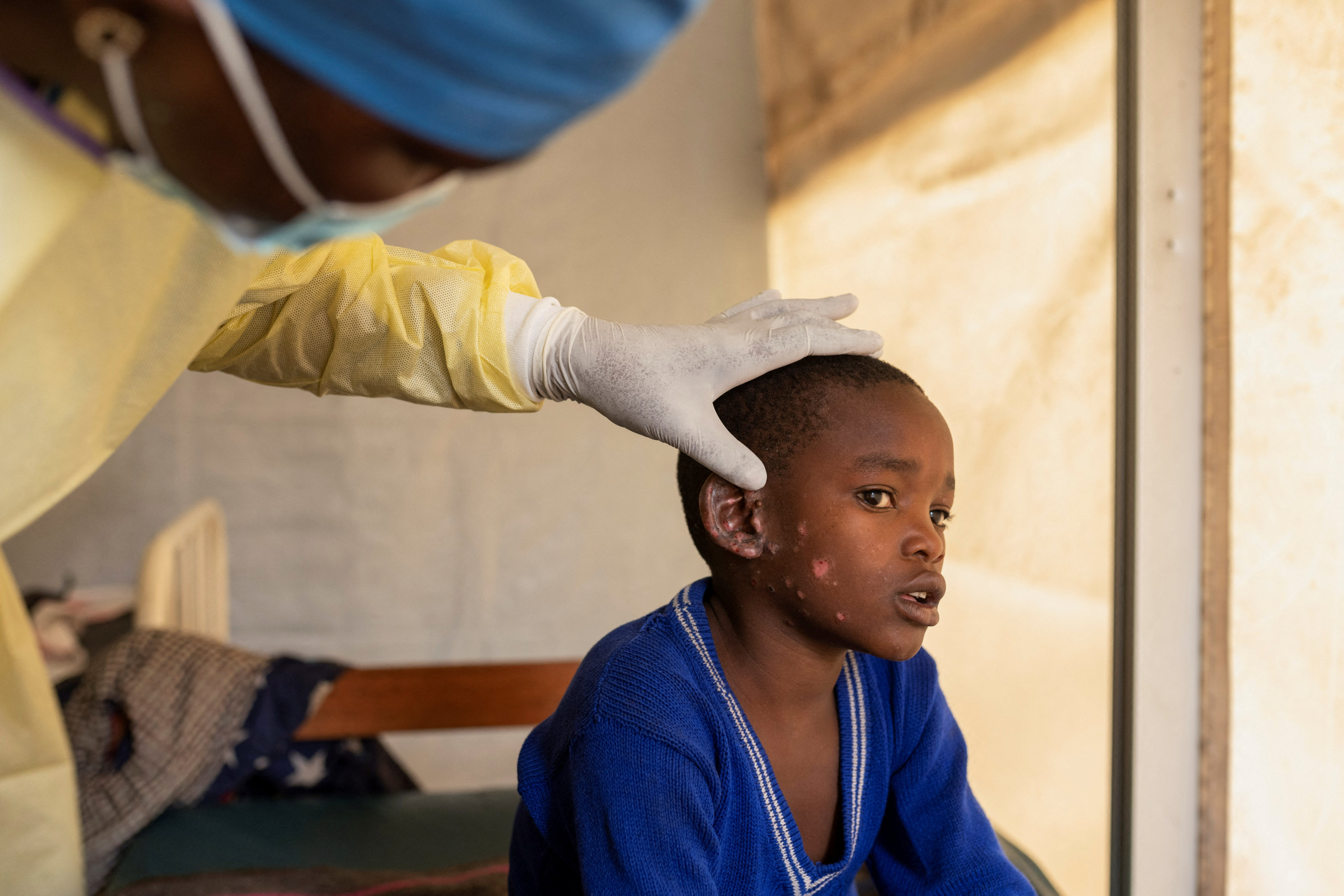 A doctor examines skin lesions on the ear of a child suffering from mpox at the treatment centre in Munigi, Democratic Republic of the Congo, in July. Photo: Reuters