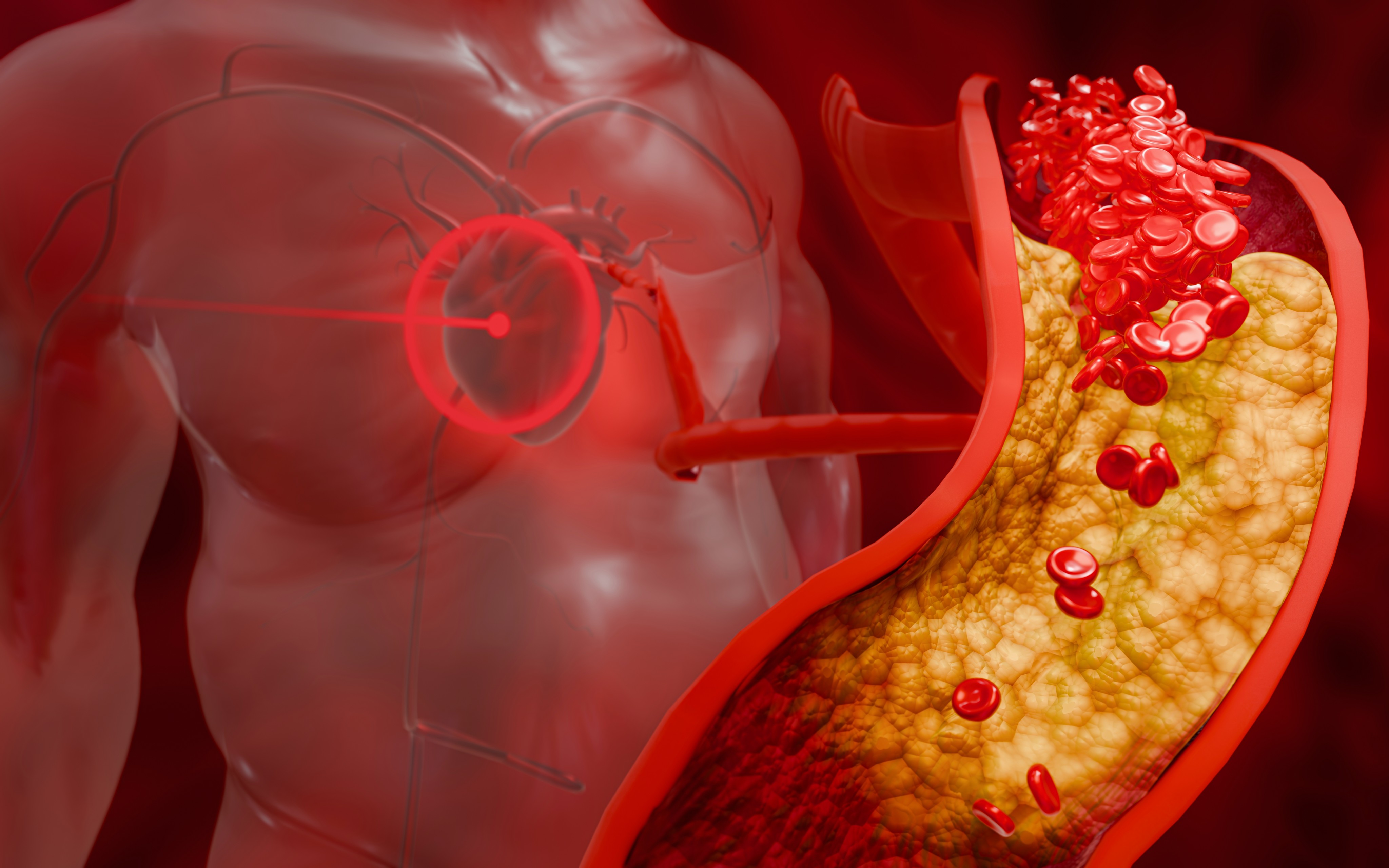 High low-density lipoprotein (LDL) cholesterol can build up in arteries and clog them, causing problems for the brain as well as the heart. Illustration: Shutterstock
