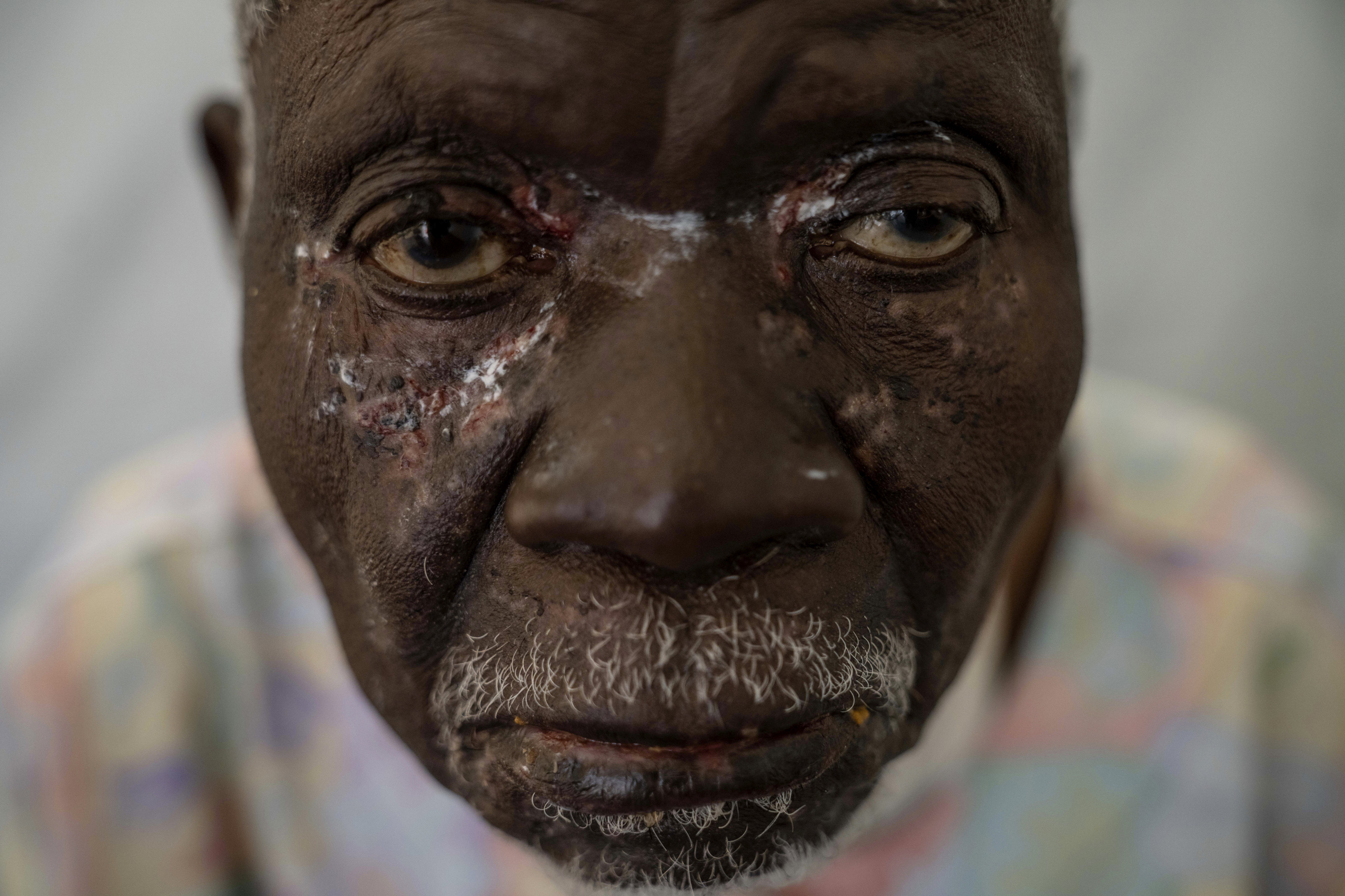 Christophe Chavilinga, 90, suffering from mpox, waits for treatment at a clinic in eastern Congo. Photo: AP