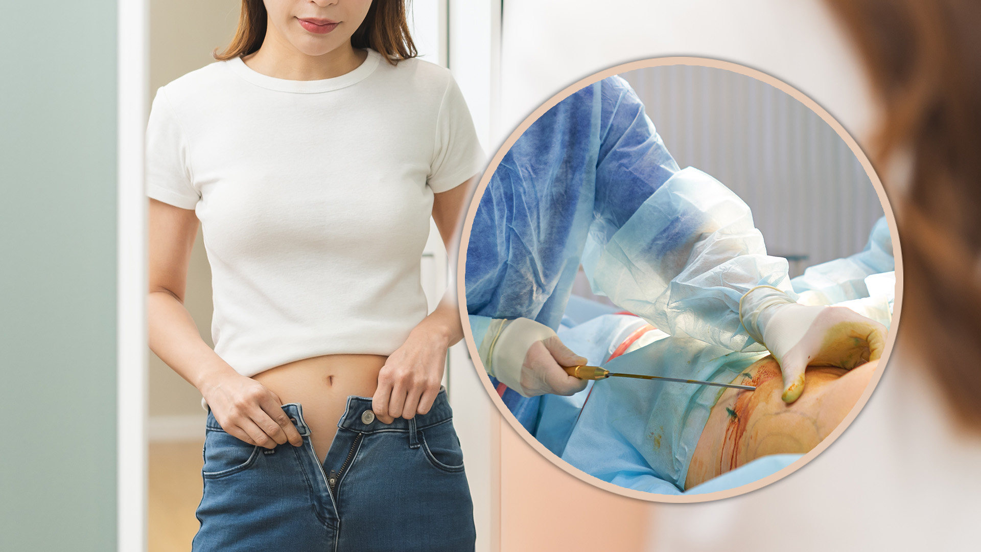 A 50-kg Chinese woman who had liposuction to remove a “little belly” has been left infertile as a result. Photo; SCMP composite/Shutterstock