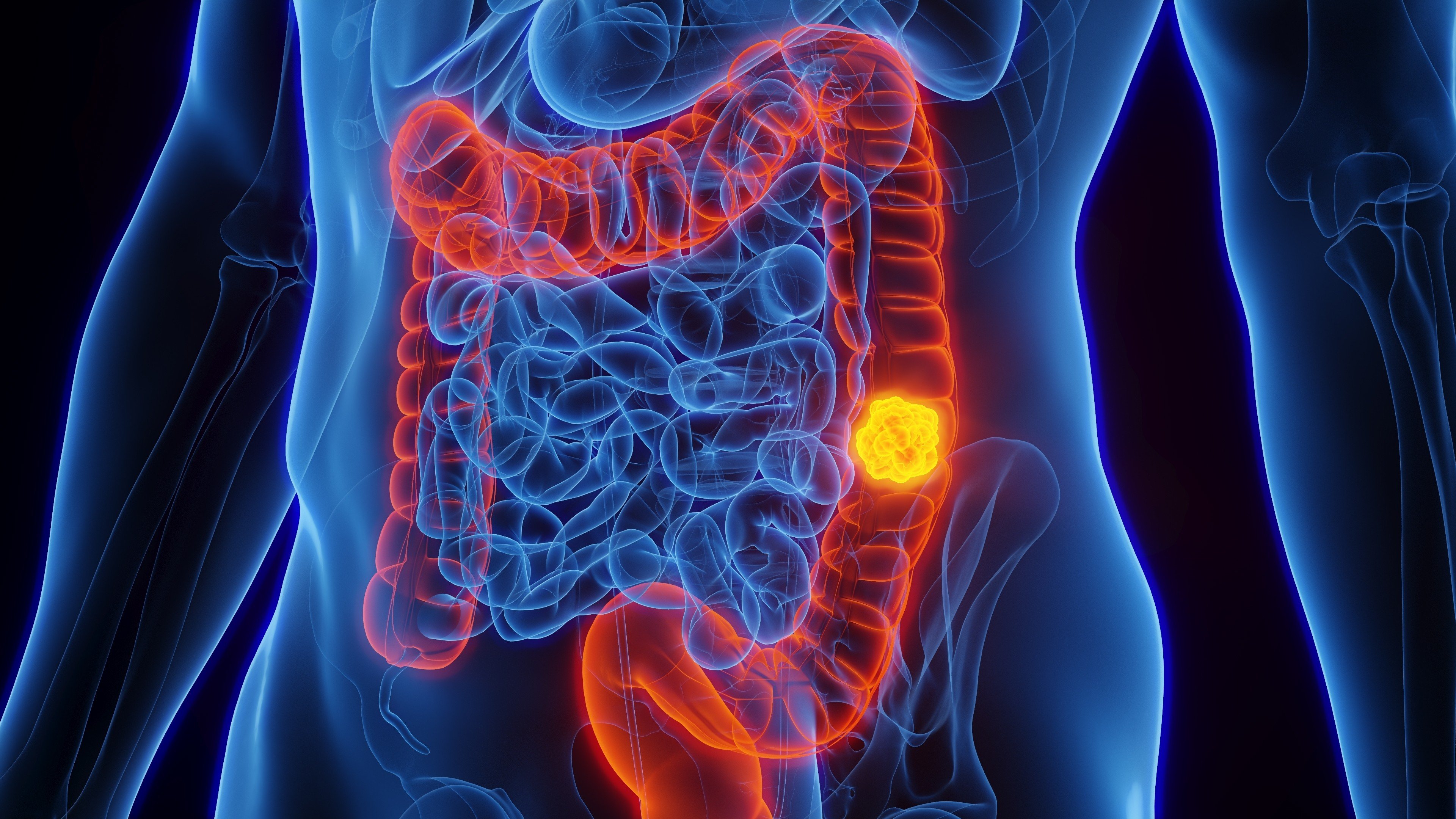 The genomes and transcriptomes of Swedish patients who had colorectal cancer have been analysed by researchers to identify genetic mutations. Photo: Shutterstock