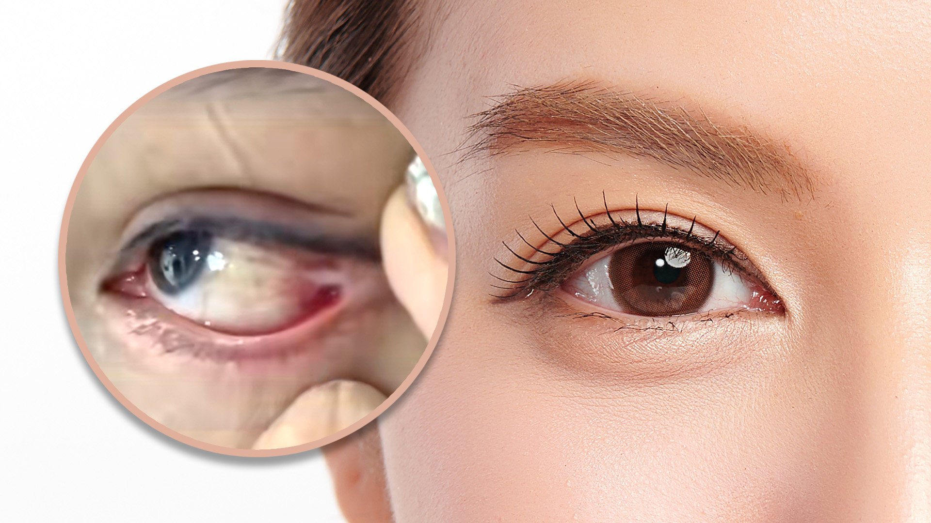 A woman in China has been left with permanent blurred vision following a bungled double eyelid cosmetic procedure. Photo: SCMP composite/Shutterstock/Douyin