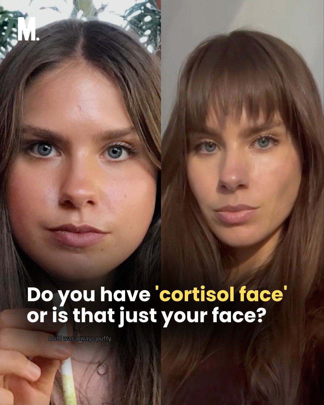 “Moon face” or “cortisol face”, a condition in which the face appears swollen and puffy, is a health concern that has been popping up online. Photo: Instagram/mamamiaaus