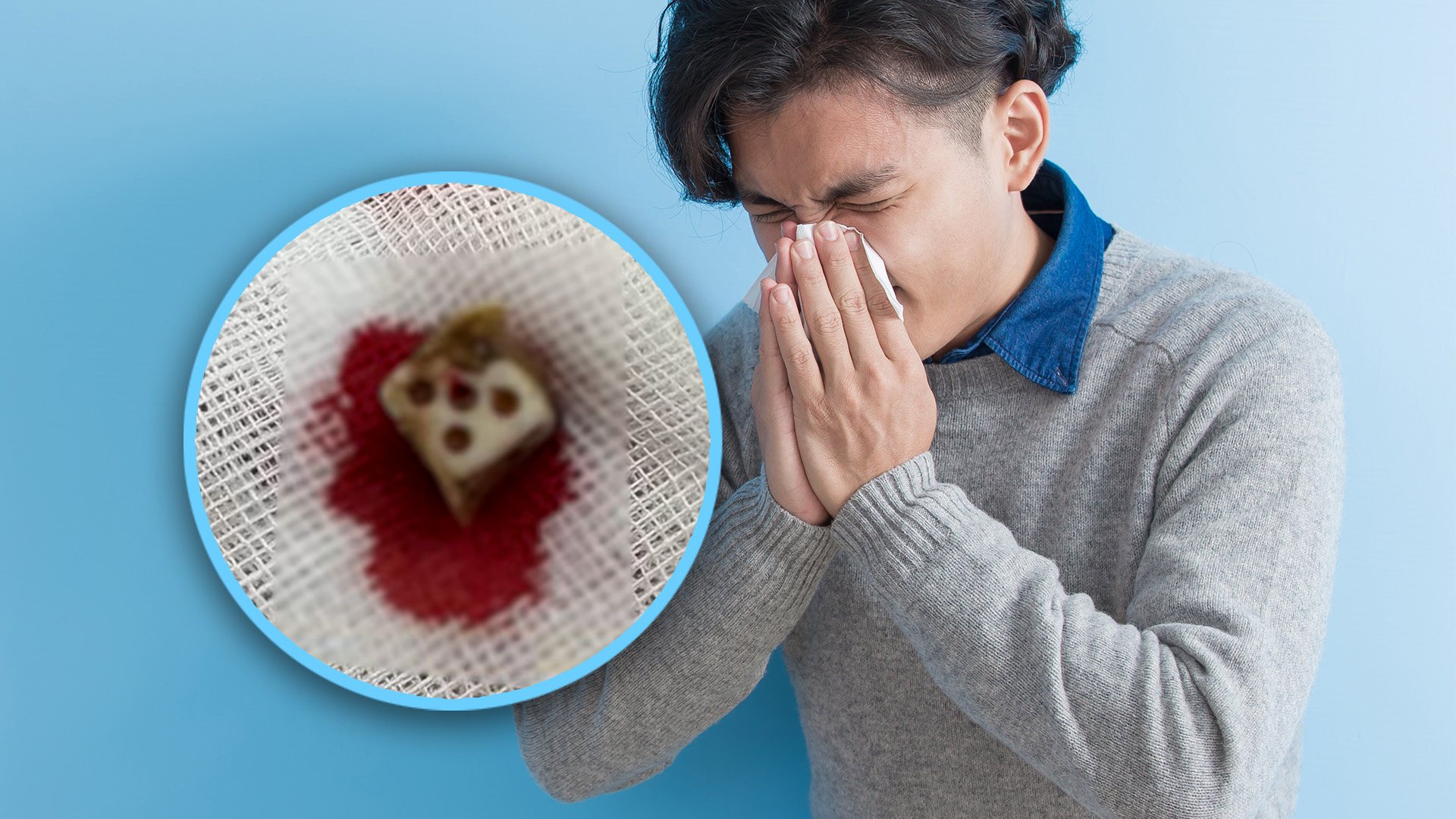 The man recalled that dice may have accidentally gone up his nose when he was about three or four, though it is unclear how it happened. Photo: SCMP composite/Shutterstock/Douyin