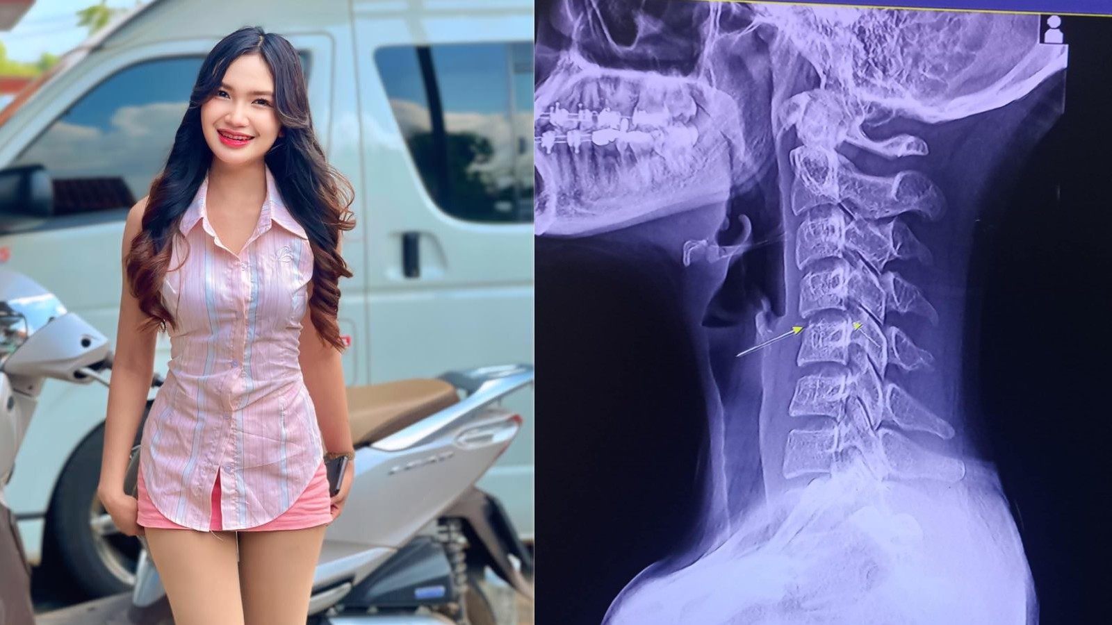 Left: Thai singer Chayada Prao-hom, who died on Sunday. Right: An x-ray image posted by Chayada to social media. Photos: Facebook / Chayada Prao-hom   