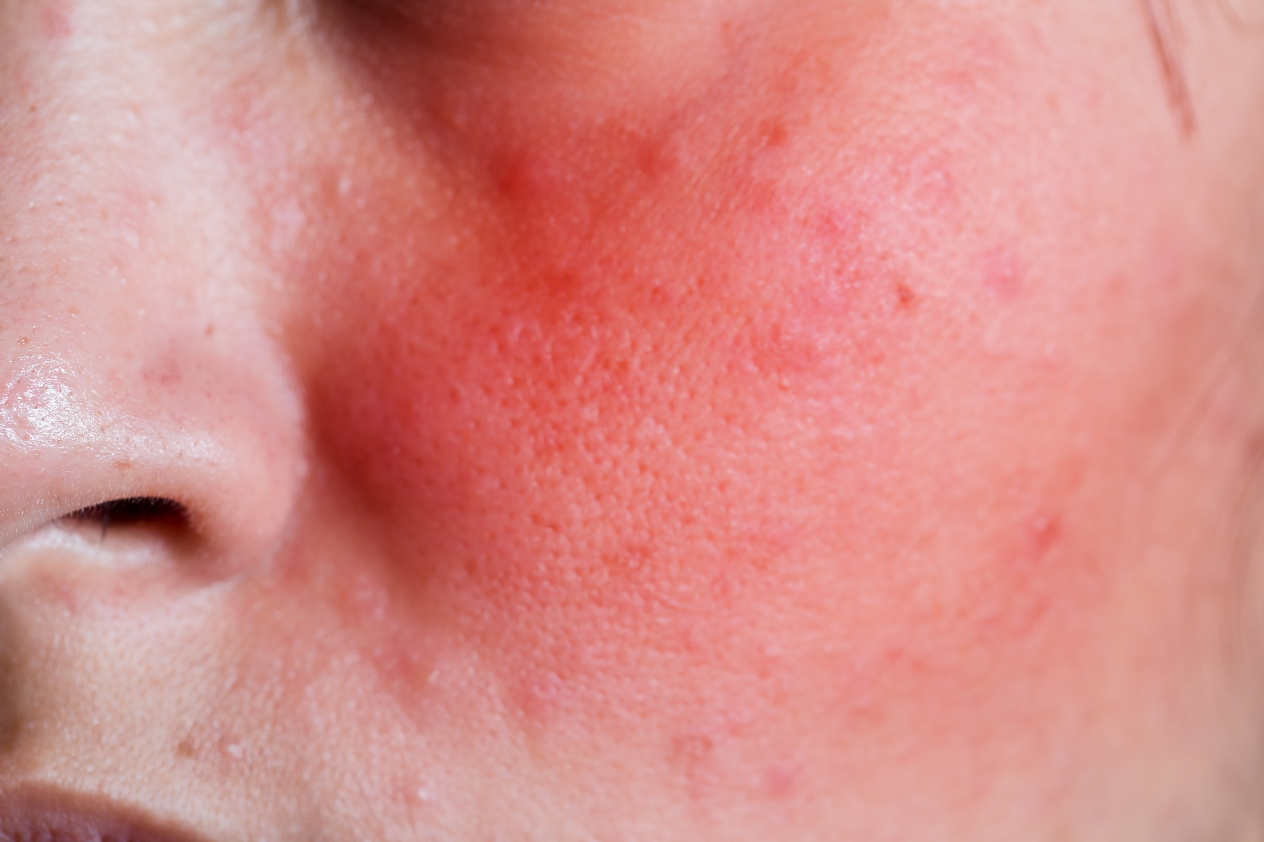 A young woman with a rash on her face. Photo: Shutterstock