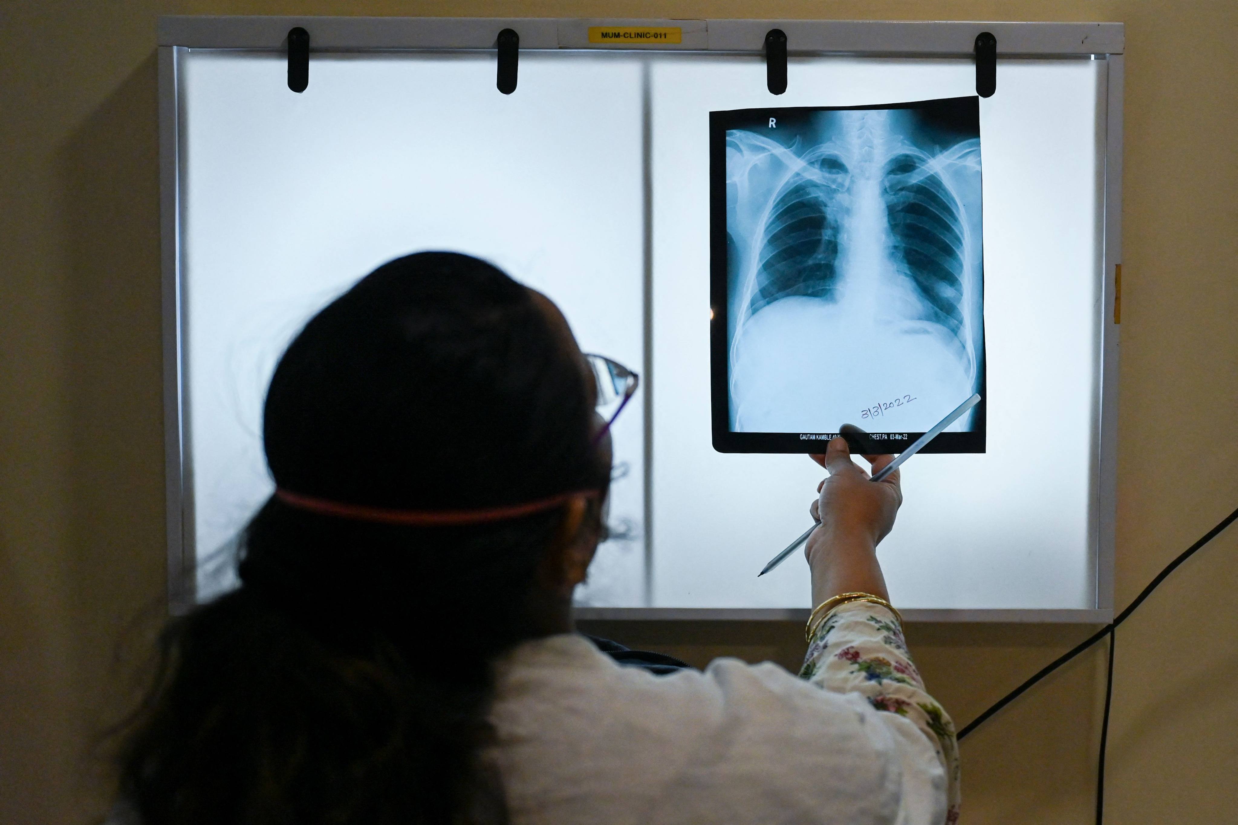 A doctor checks a tuberculosis patient’s chest X-rays at a clinic in Mumbai. Photo: AFP