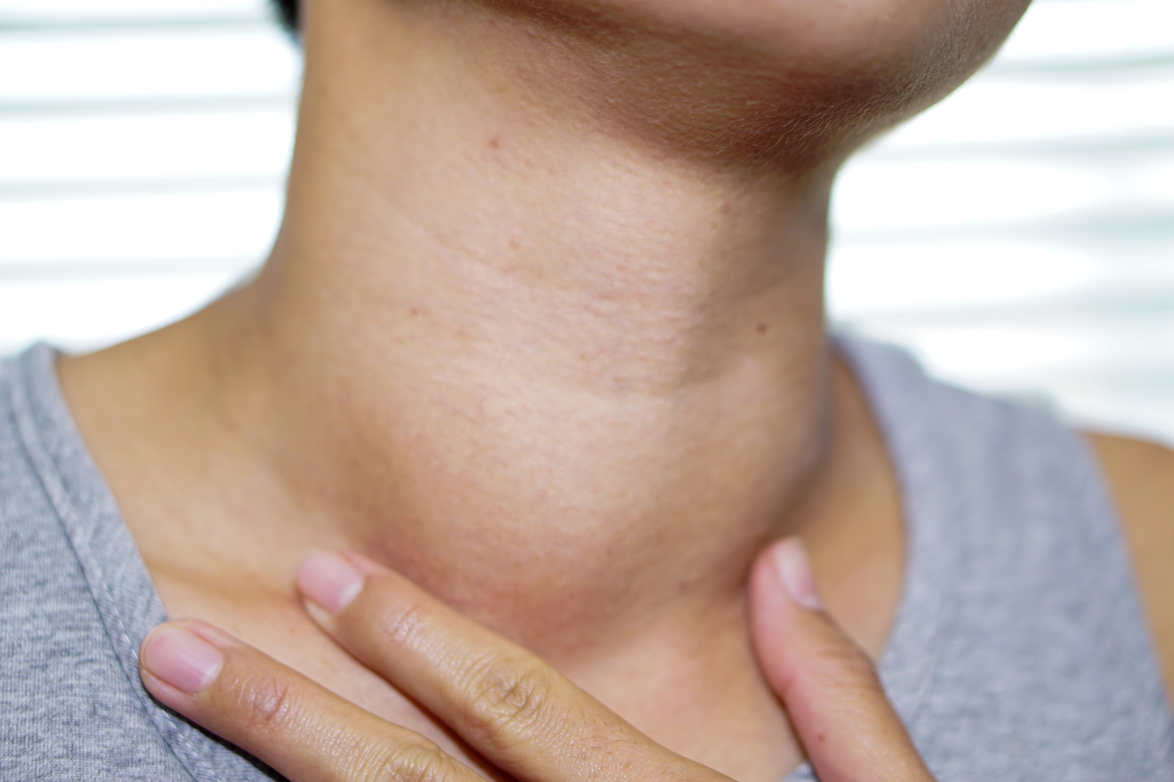 A swelling of the neck, known as a goitre, is a telltale sign of iodine deficiency. Photo: Shutterstock