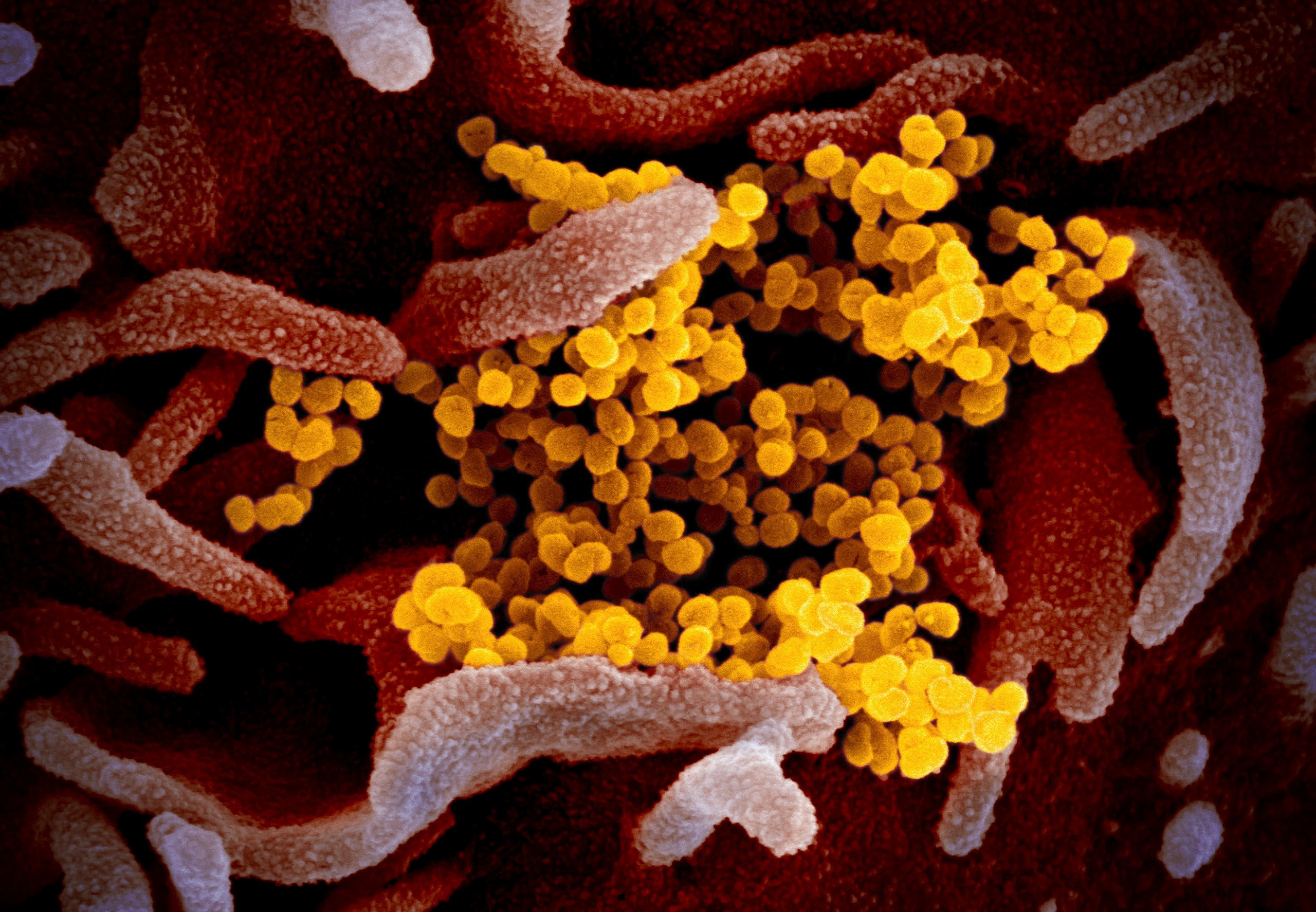 An electron microscope shows the coronavirus, in yellow, emerging from the surface of cells. Image: NIAID-RML via AP