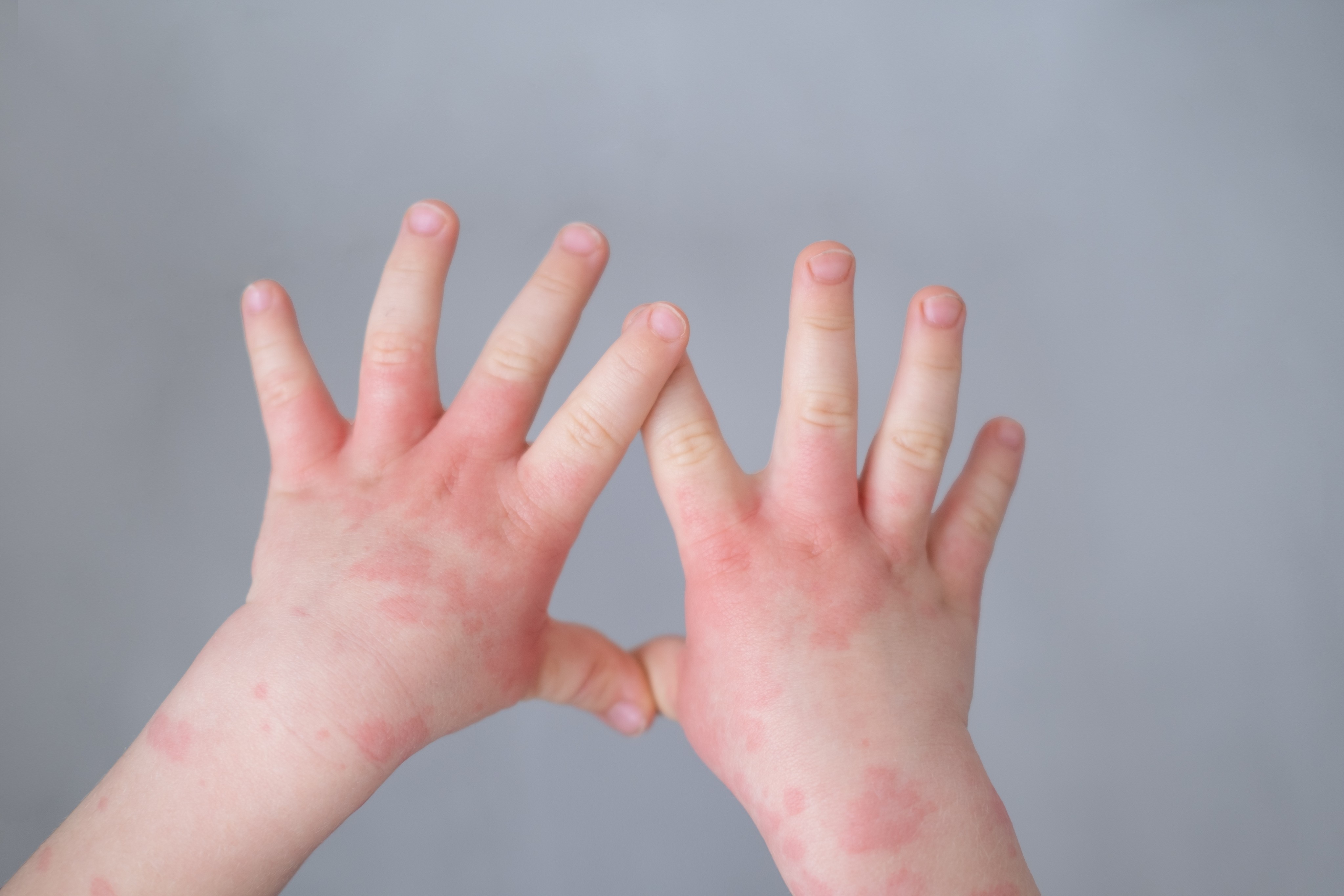 Increased cleaning during the pandemic may have led to a rise in eczema cases among infants. Photo: Shutterstock 