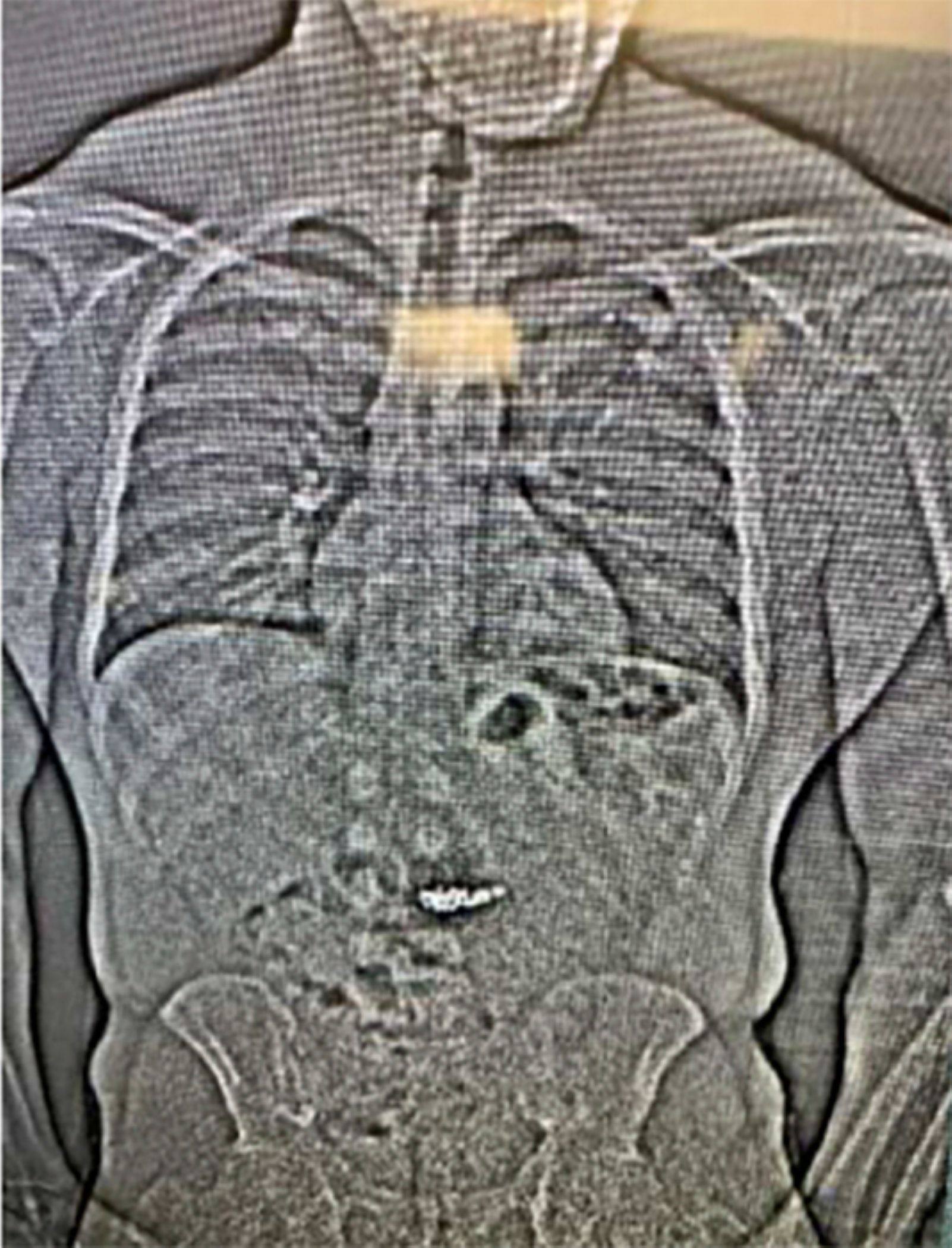 An X-ray shows what are believed to be two diamond earrings that were stolen from a Tiffany & Co. jewelry store in central Florida and were swallowed by the suspect. Image: Orlando Police Department office via AP