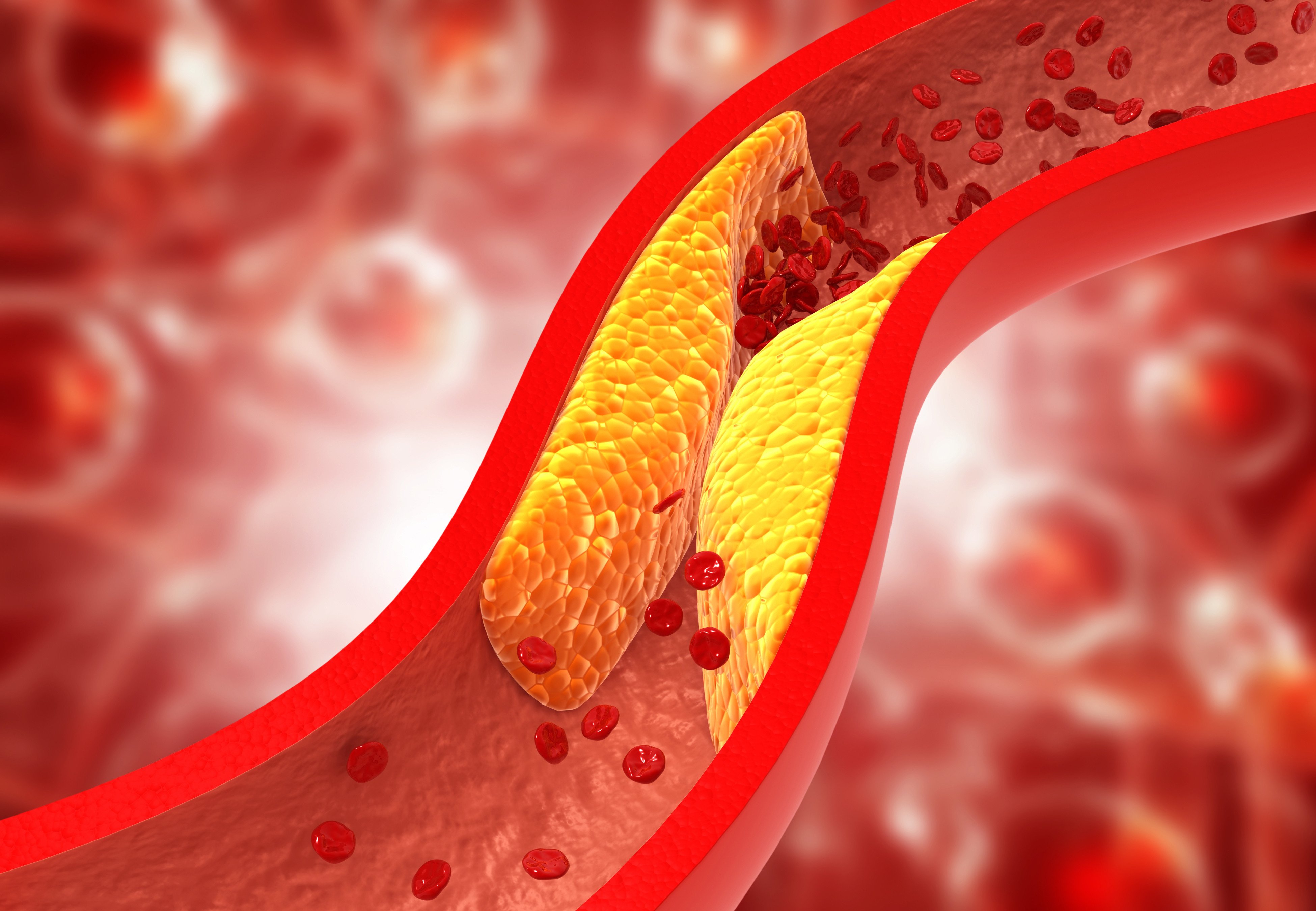 A build-up of plaque – a deposit of fatty substances, cholesterol and cellular waste – in the arteries can lead to blood clots, stroke and heart attacks. Illustration: Shutterstock