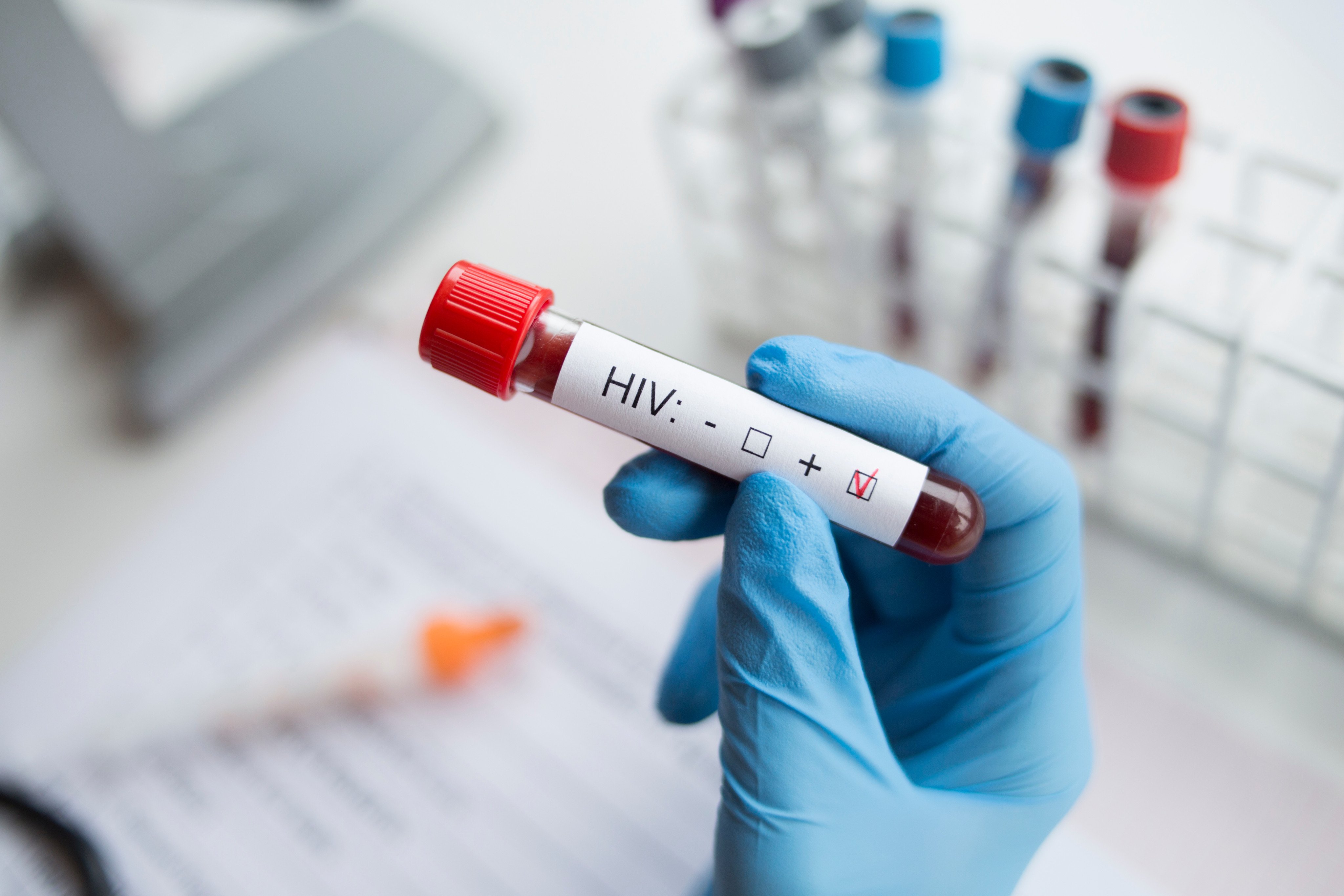 A diagnostician holds a positive HIV test. Photo: Shutterstock