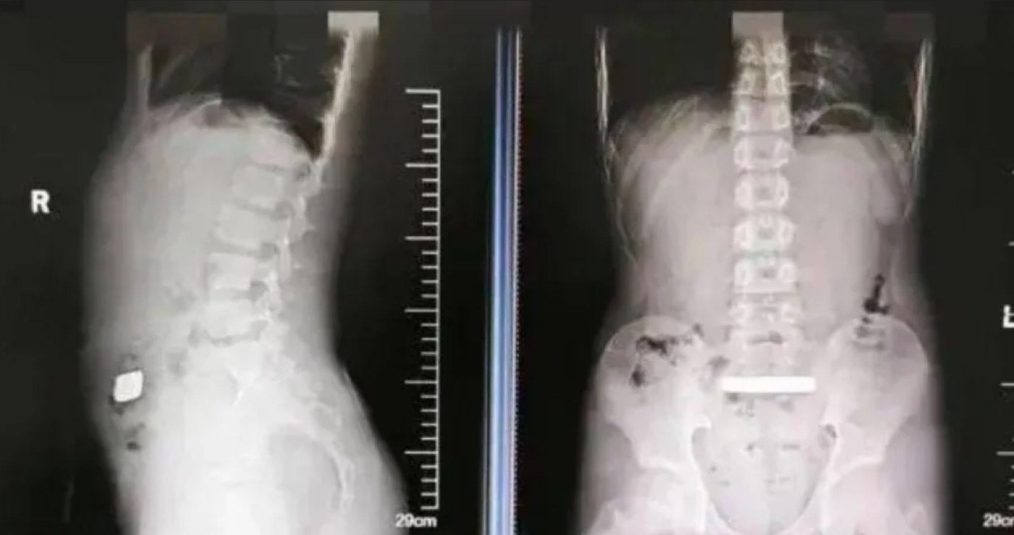 An X-ray revealed a high-density metallic object trapped in the boy’s intestines. Photo: Douyin An X-ray revealed a high-density metallic object trapped in the boy’s intestines. Photo: Douyin
