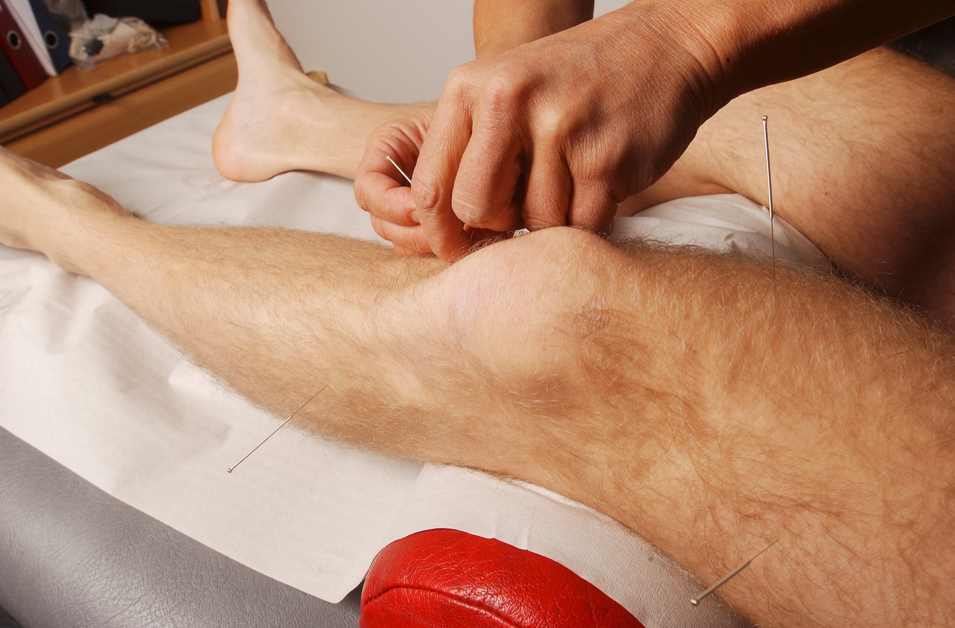 A Hong Kong man has suffered a flesh-eating infection after an acupuncture treatment, which has led to the amputation of his left leg. Photo: Getty Images