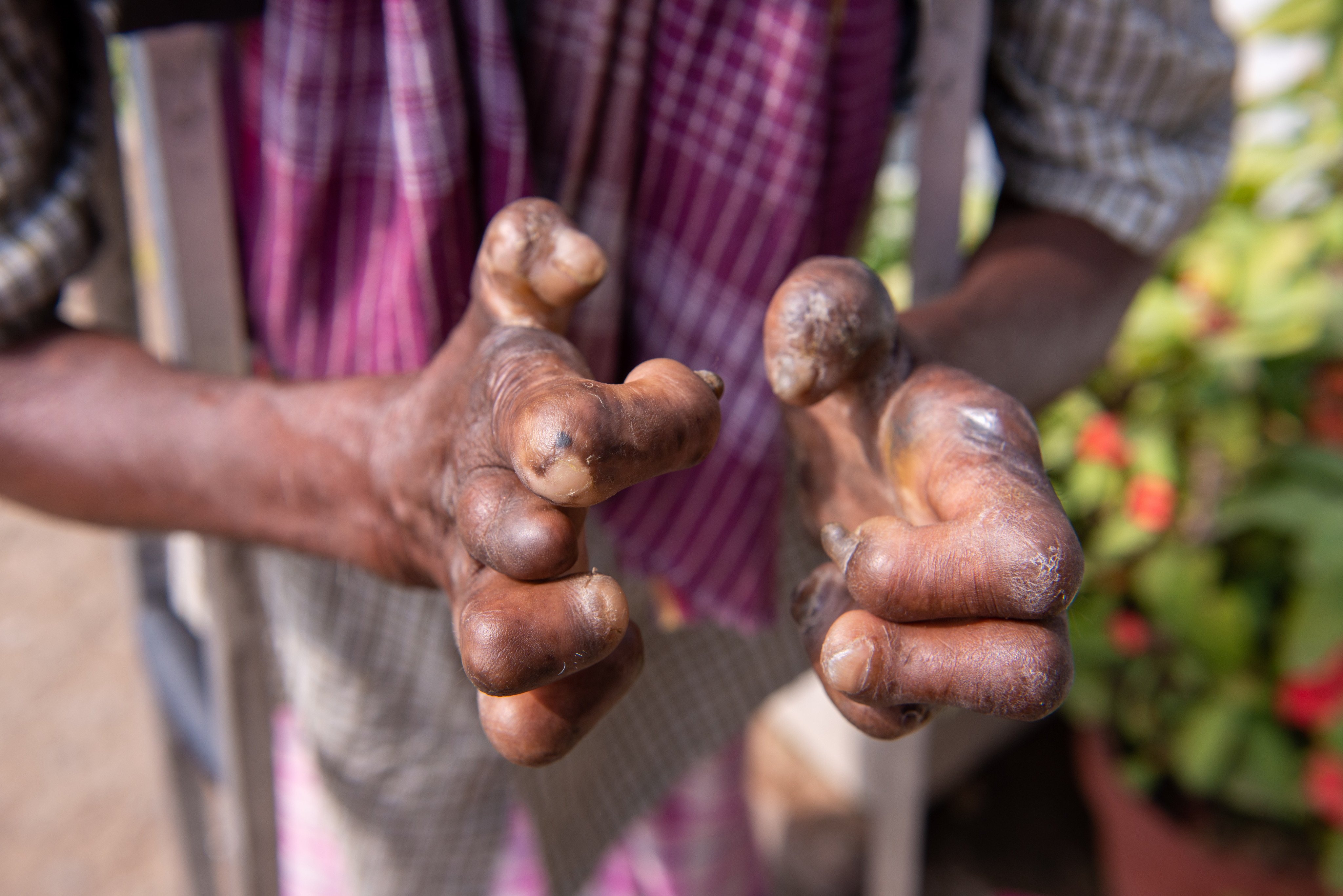 Close up of a person suffering from leprosy. Photo: Shutterstock