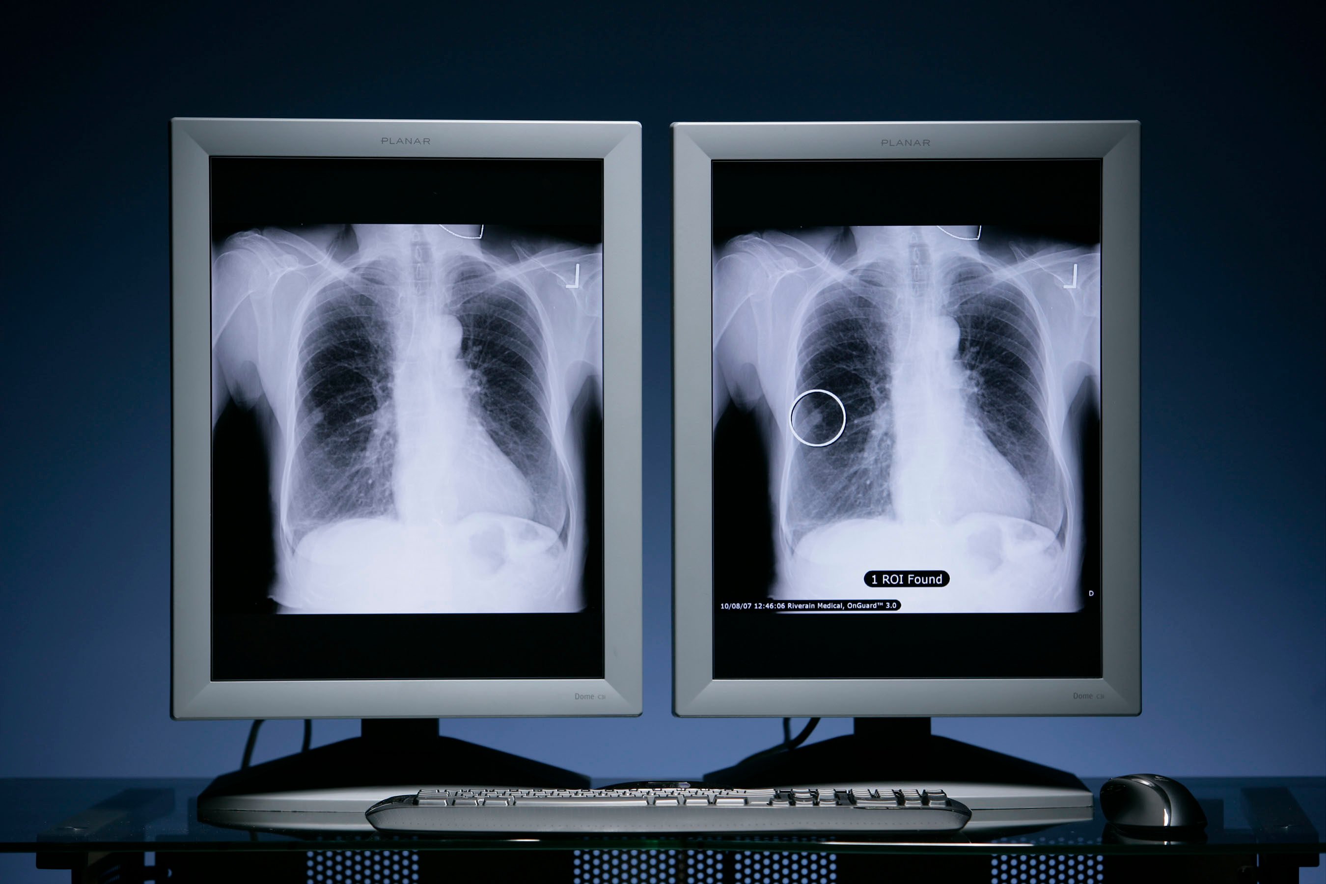 Lung cancer is the most prevalent type of the disease worldwide, with an estimated 2.5 million new cases globally last year. Photo: PR NEWSWIRE
