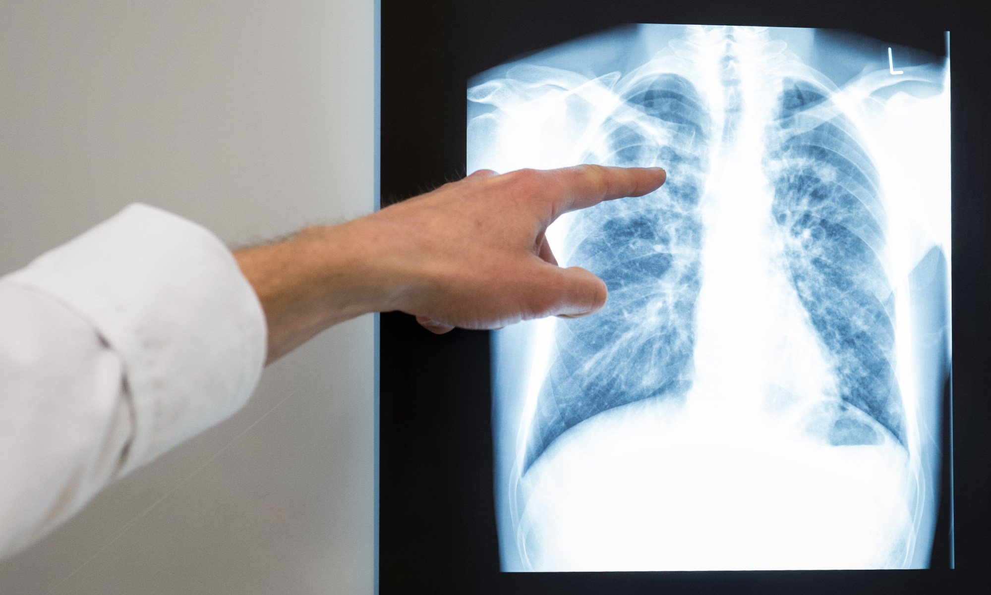 TB is a serious illness primarily affecting the lungs, caused by bacteria that spreads through the air. Photo: dpa TB is a serious illness primarily affecting the lungs, caused by bacteria that spreads through the air. Photo: dpa
