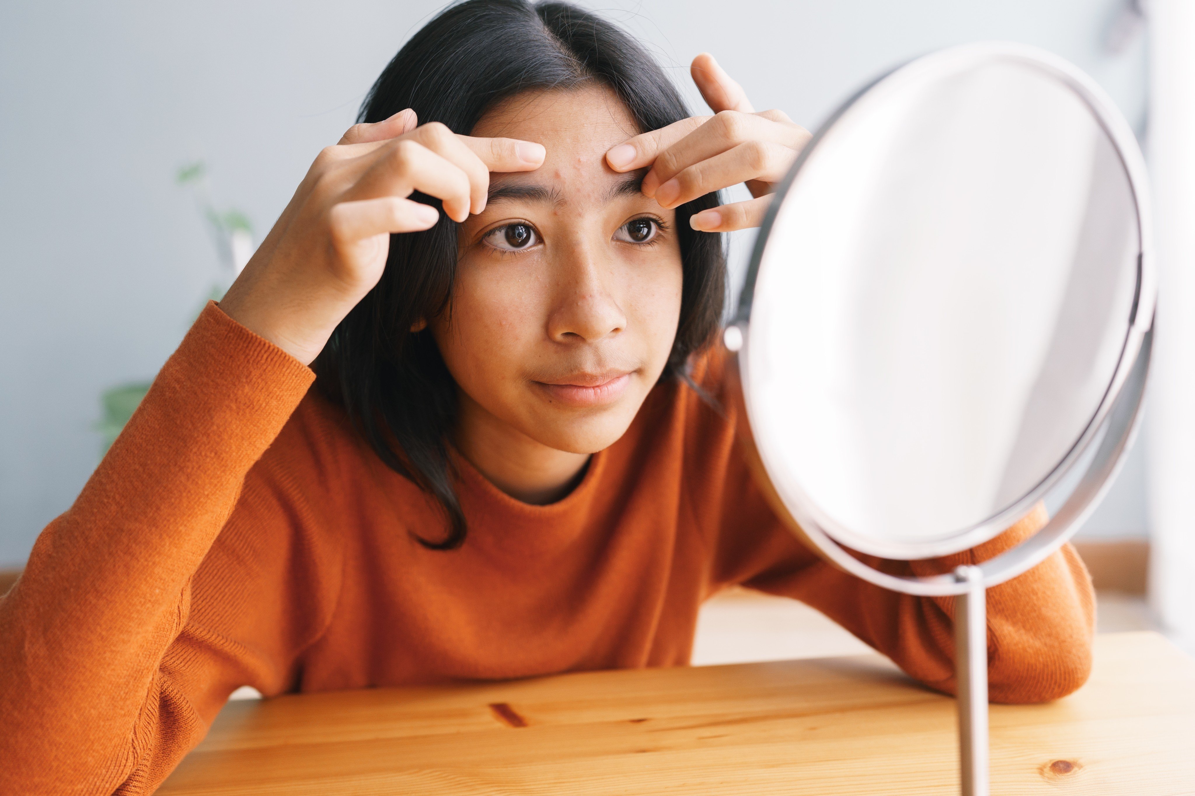 Teenage pimples are like surprise guests at a party -uninvited, awkward and always showing up right before the big event. Photo: Shutterstock