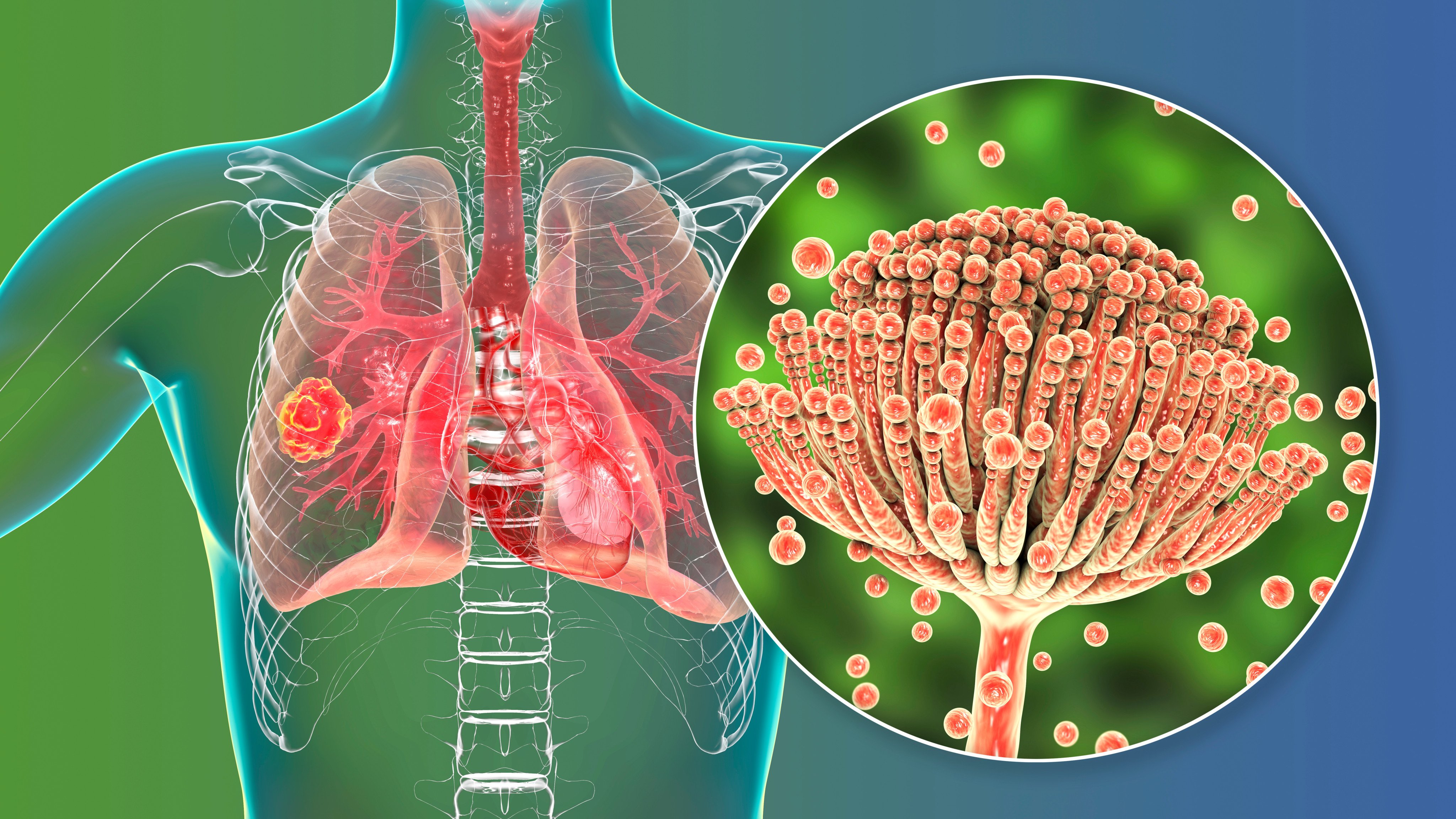 Antifungal resistance, linked to overuse in agriculture and medicine, poses growing global health risks. Photo: Shutterstock