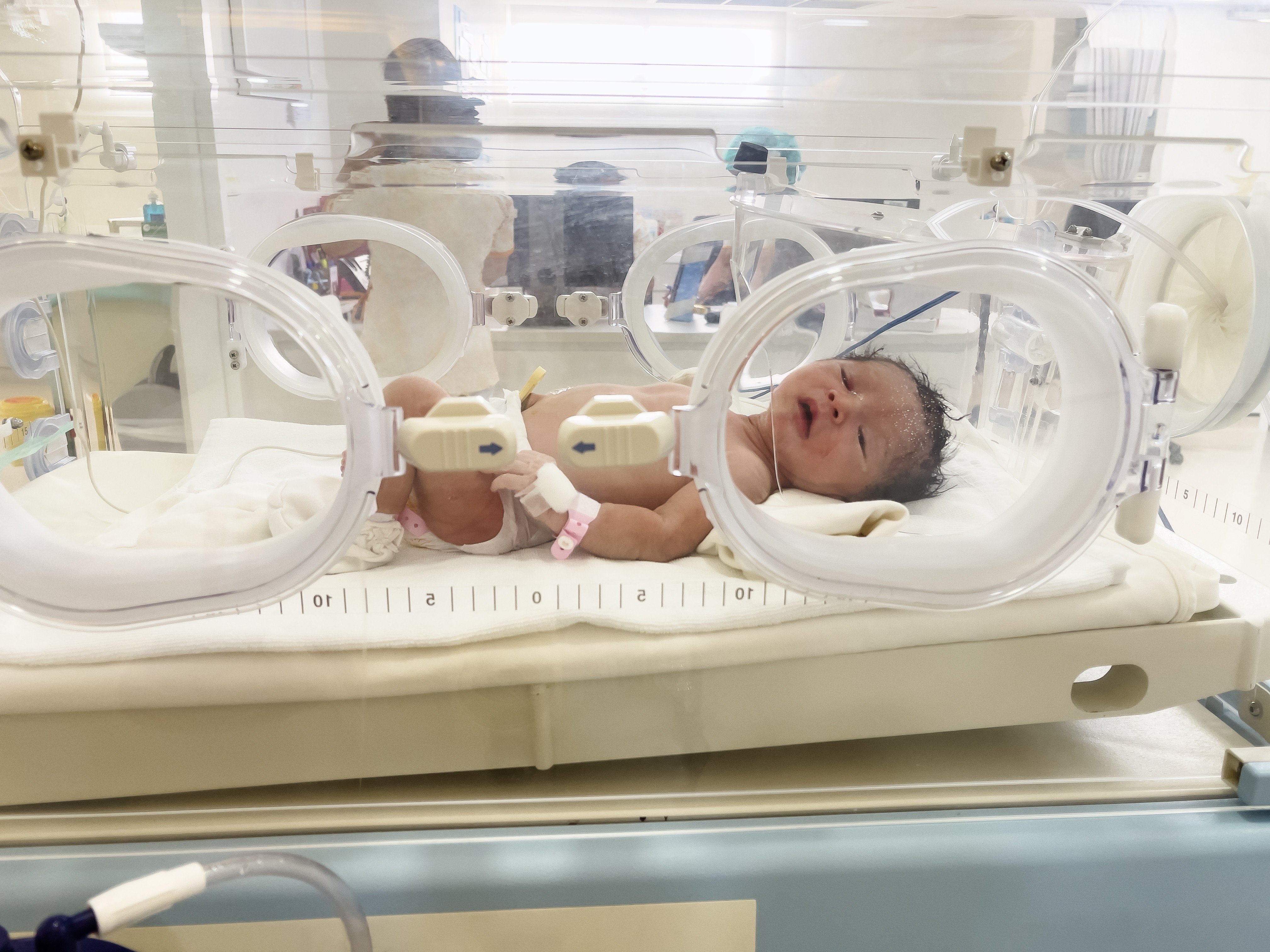 After surgery, babies born with congenital heart defects typically need a pacemaker for about a week while their hearts heal from surgery. Photo: Shutterstock