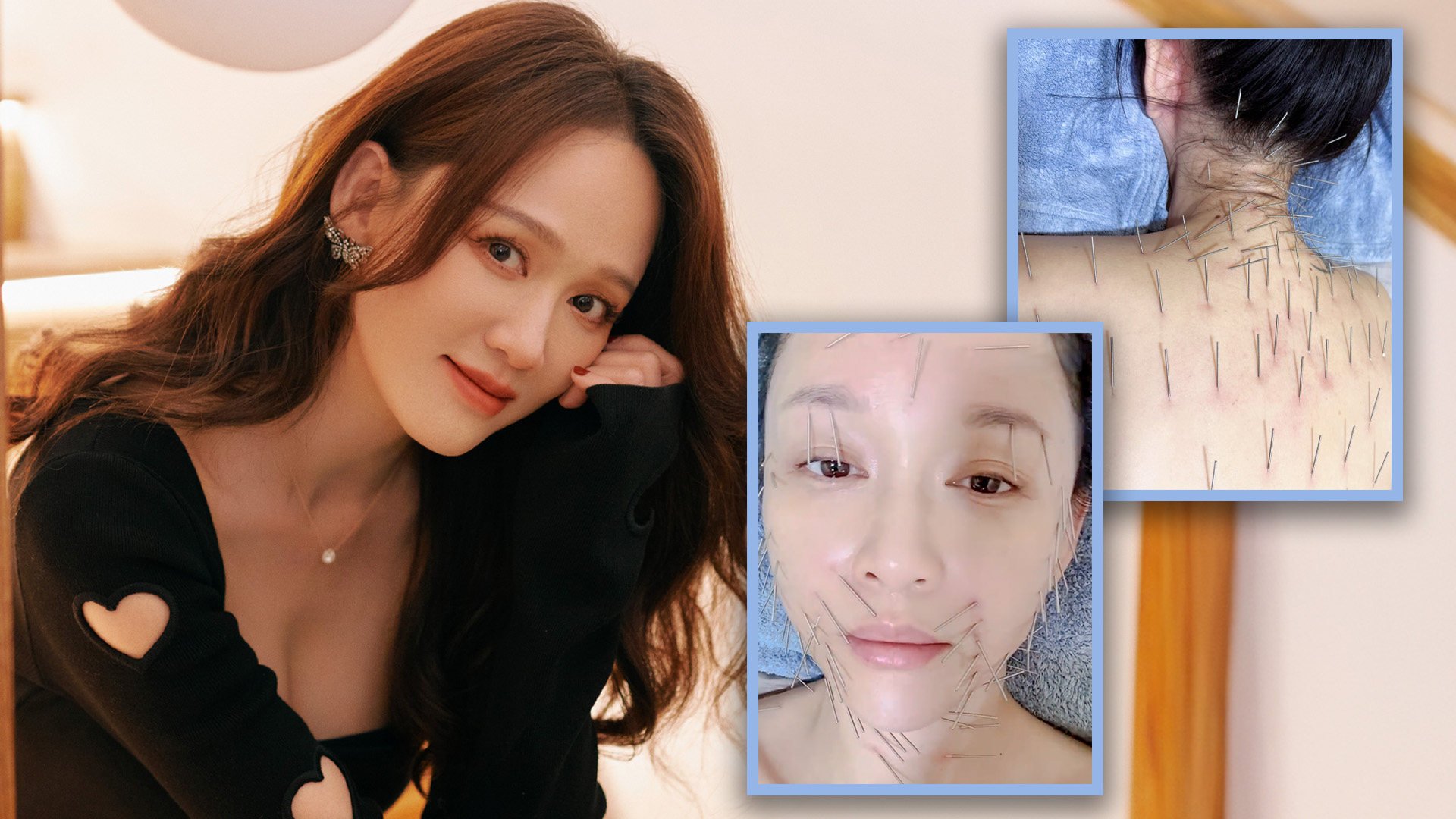 A Taiwanese actress has shocked social media after she posted photos of her face and body pinned with fine needles during an acupuncture treatment. Photo: SCMP composite/Weibo