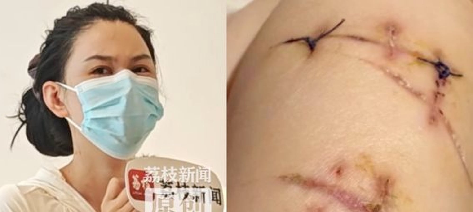 Doctors said Ma suffered more than 20 stab wounds, of which only one came close to her lung. Photo: Handout