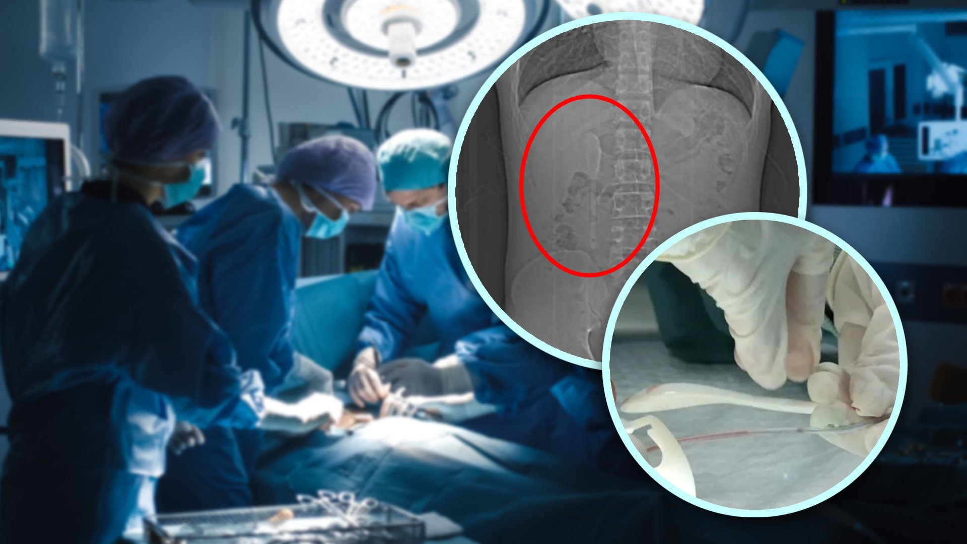 A Chinese man, under the influence of alcohol, mistakenly swallowed a coffee spoon in Thailand, believing it was part of a dream, and only realised the error five months later. Photo: SCMP composite/Shutterstock/QQ.com
