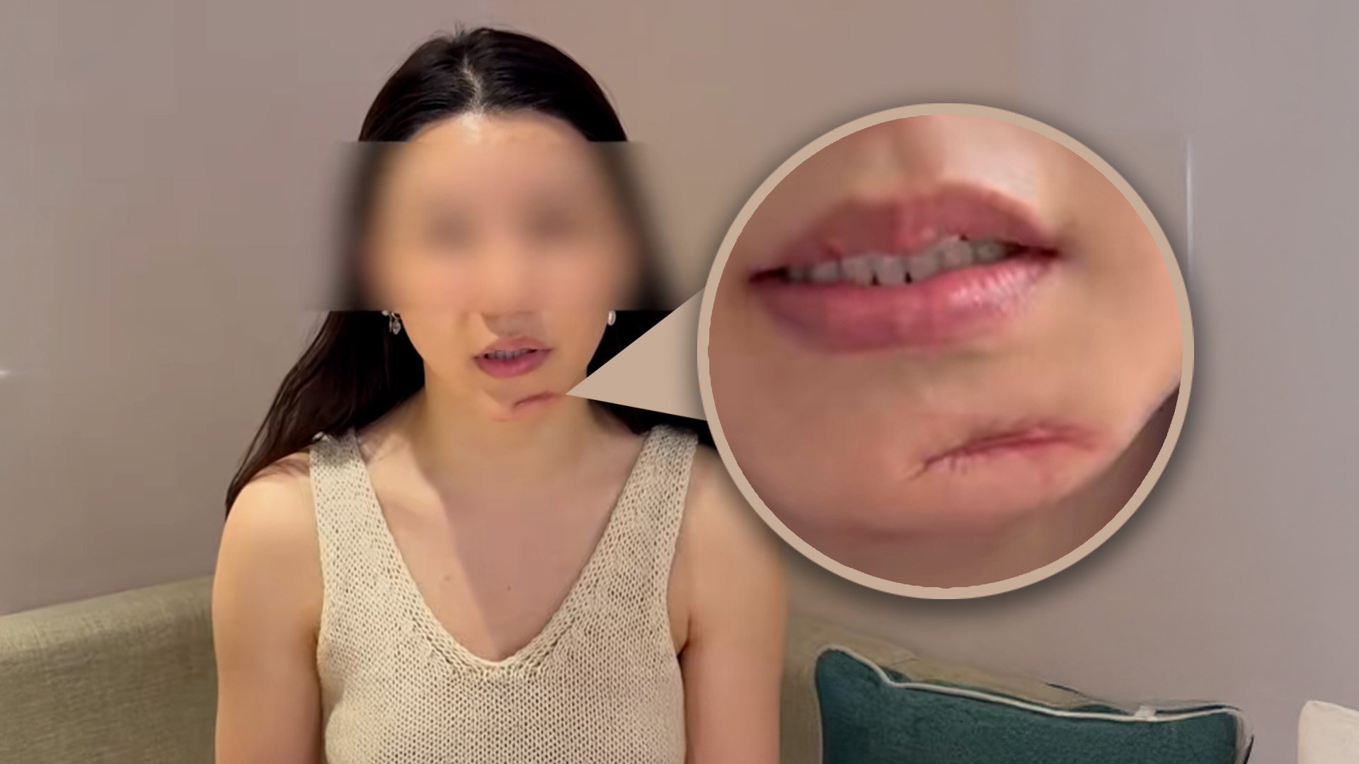 A woman in China is seeking compensation after botched surgery left her with a six-centimetre-long scar on her chin. Photo: SCMP composite/Douyin