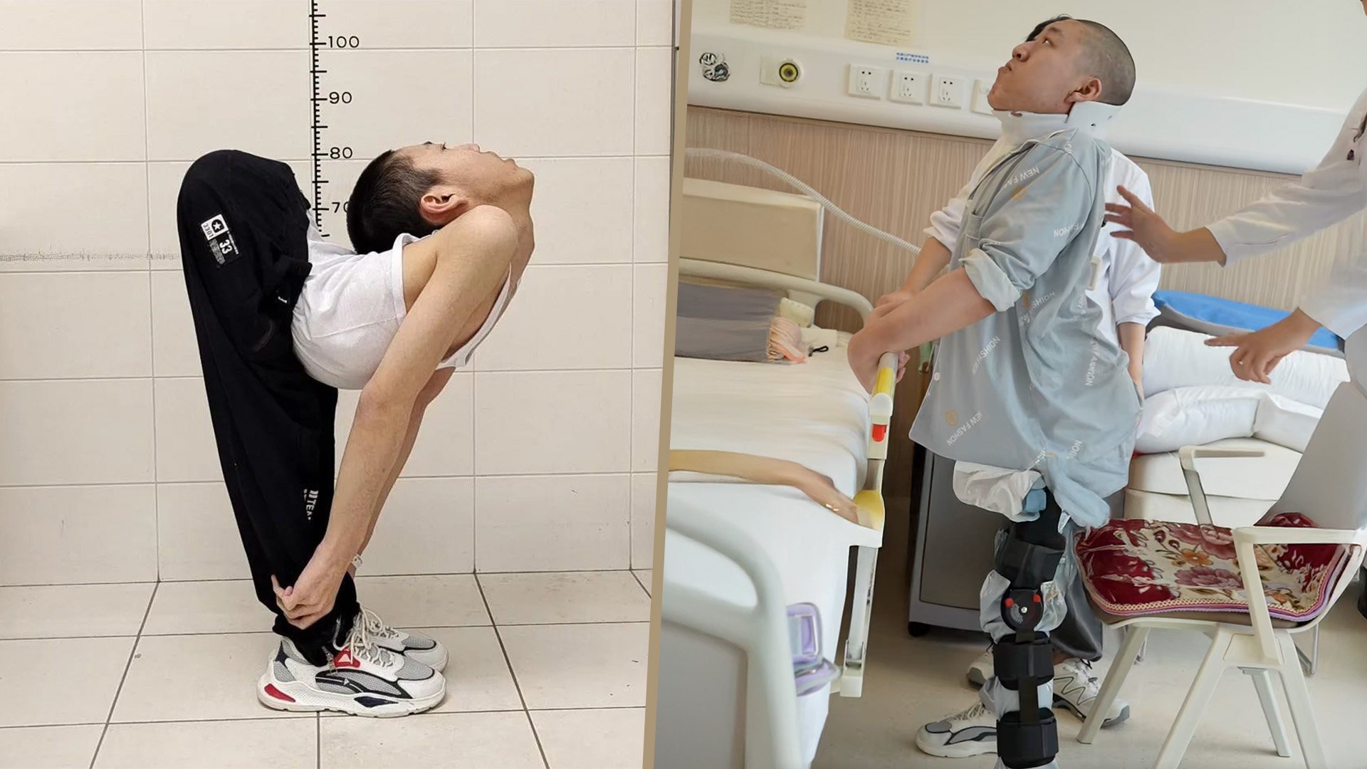 China’s “folded boy” stands upright for the first time after undergoing complex surgeries to break and reset his bones. Photo: SCMP composite/news.pku.edu.cn/Douyin