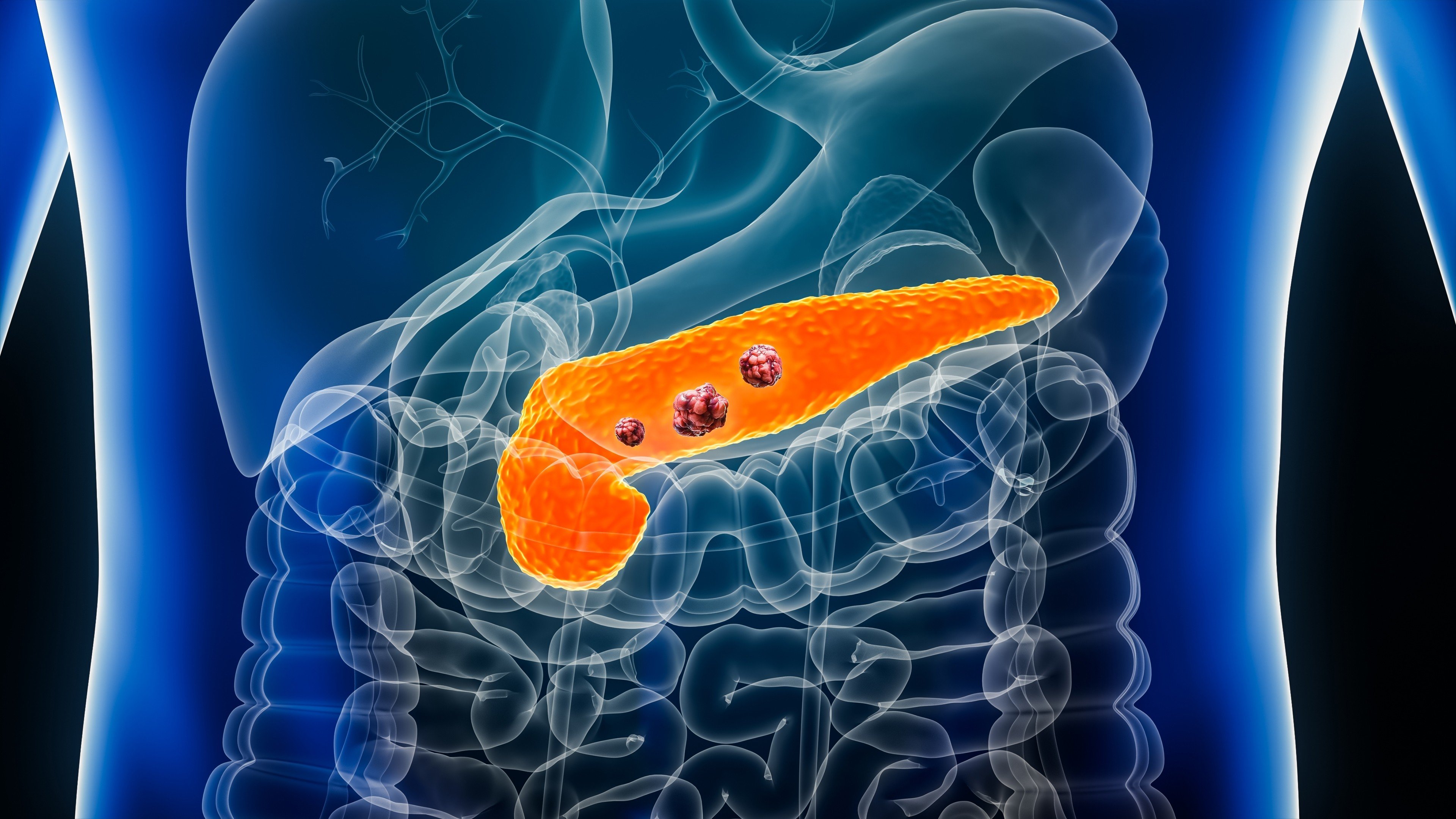 Analysis of samples from patients with pancreatic, breast and colorectal cancers showed cells that act as the “intelligence agents” of the immune system can become severely depleted as the tumour progresses. Sildenafil is able to reverse the process, the research team says. Photo: Shutterstock