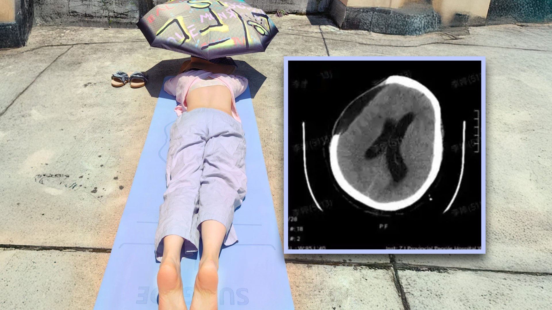 A 67-year-old woman in China suffered a brain haemorrhage and ended up in a coma after sunbathing to improve her health. Photo: SCMP composite/RedNote/Baidu