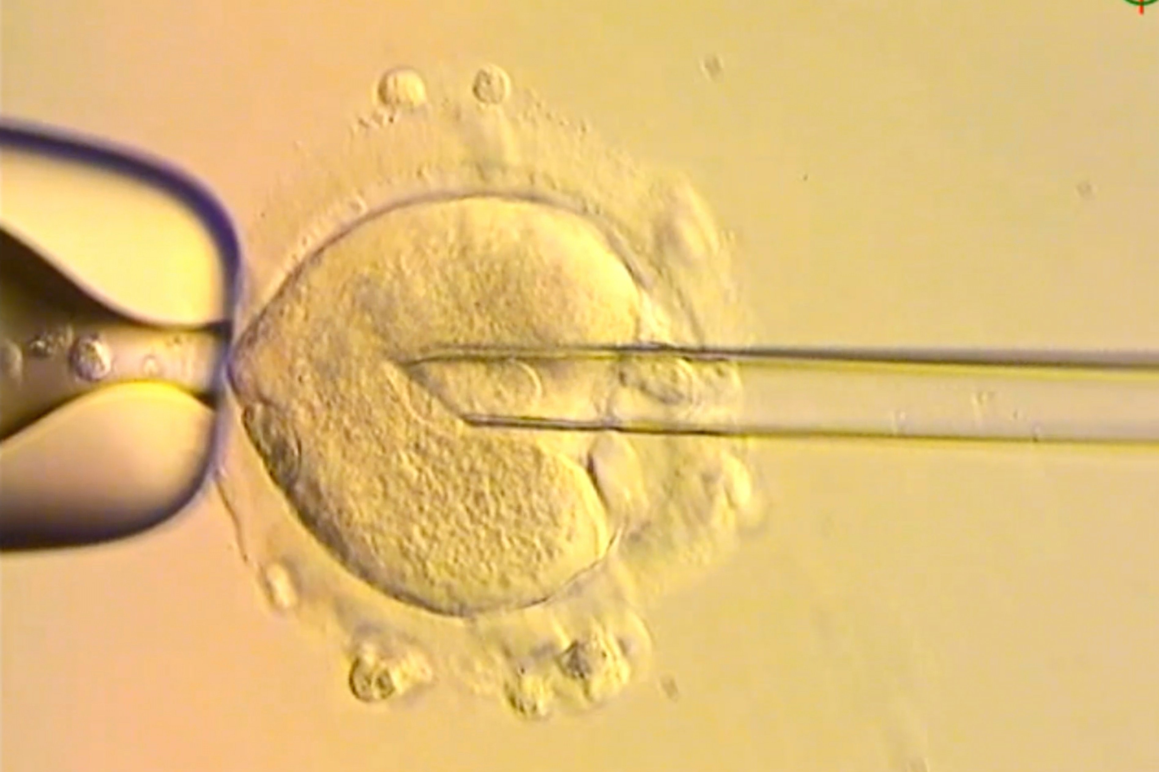 A nuclear genome from an egg carrying a mitochondrial DNA mutation being inserted into an egg donated by an unaffected woman. Photo: Newcastle Fertility Centre, Newcastle Hospitals NHS Foundation Trust via AP