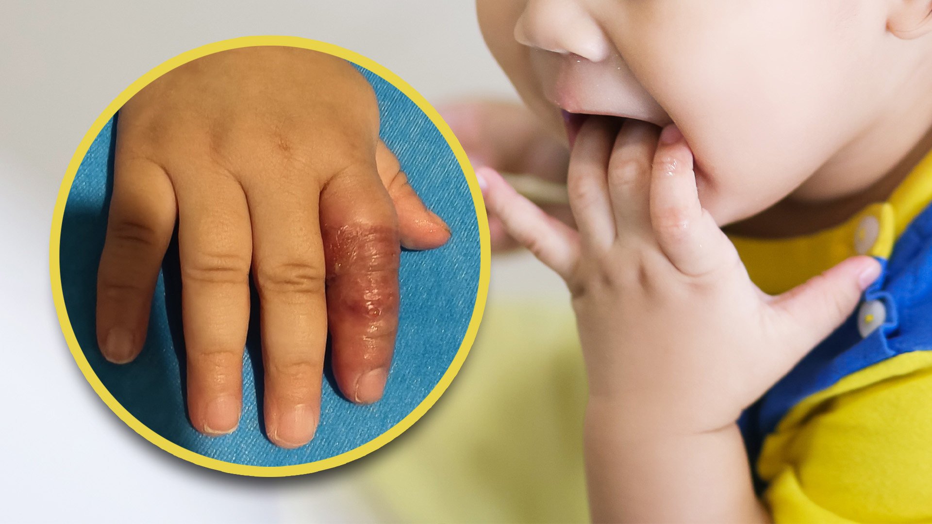 A Chinese mother wrapped- up her baby’s index finger to stop the child from sucking it and almost caused the digit to be amputated. Photo: SCMP composite/Shutterstock/Weibo