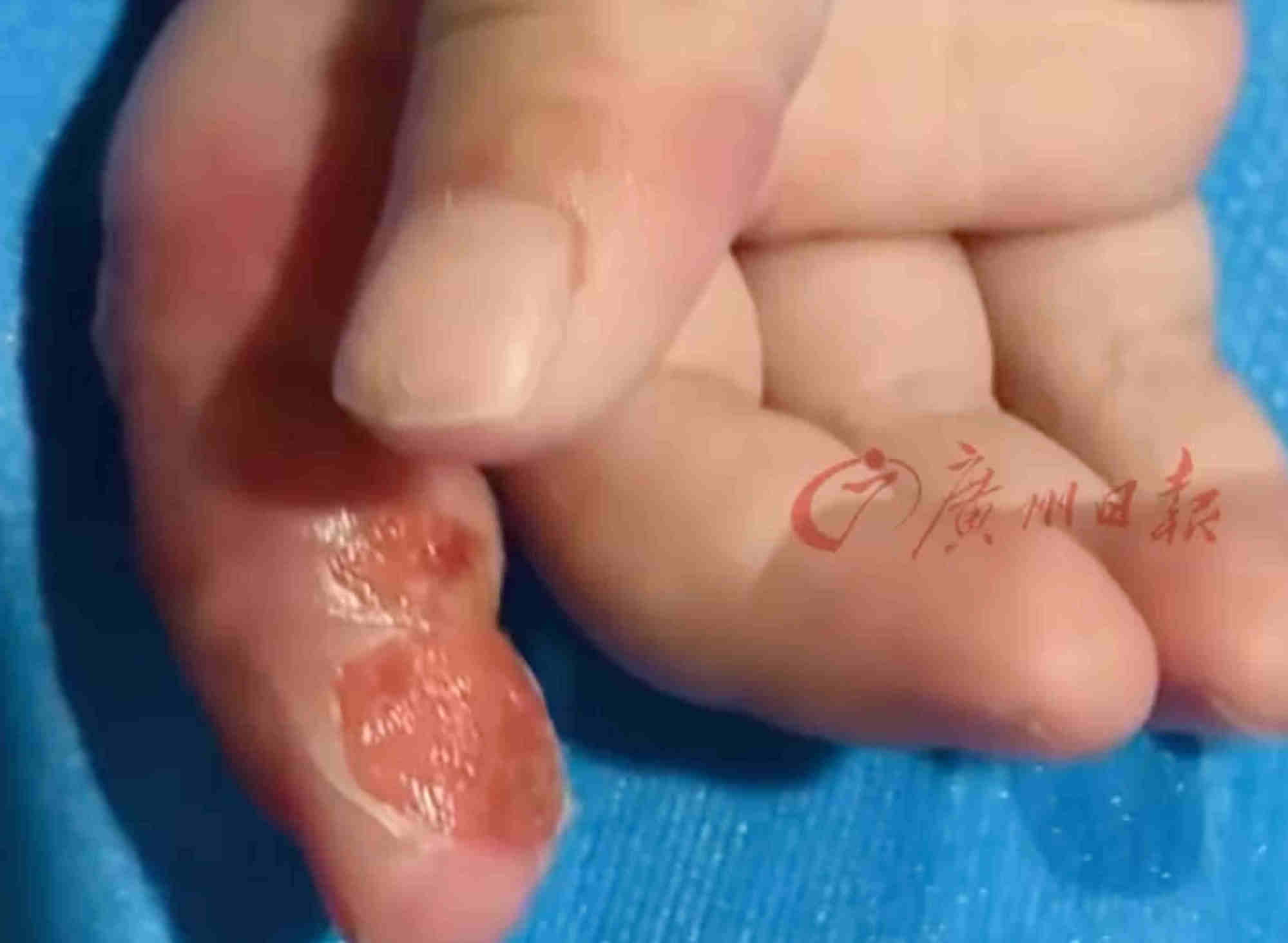 Little Lele’s index finger became swollen and discoloured as a result of her mother wrapping it up. Photo: Sina Little Lele’s index finger became swollen and discoloured as a result of her mother wrapping it up. Photo: Sina