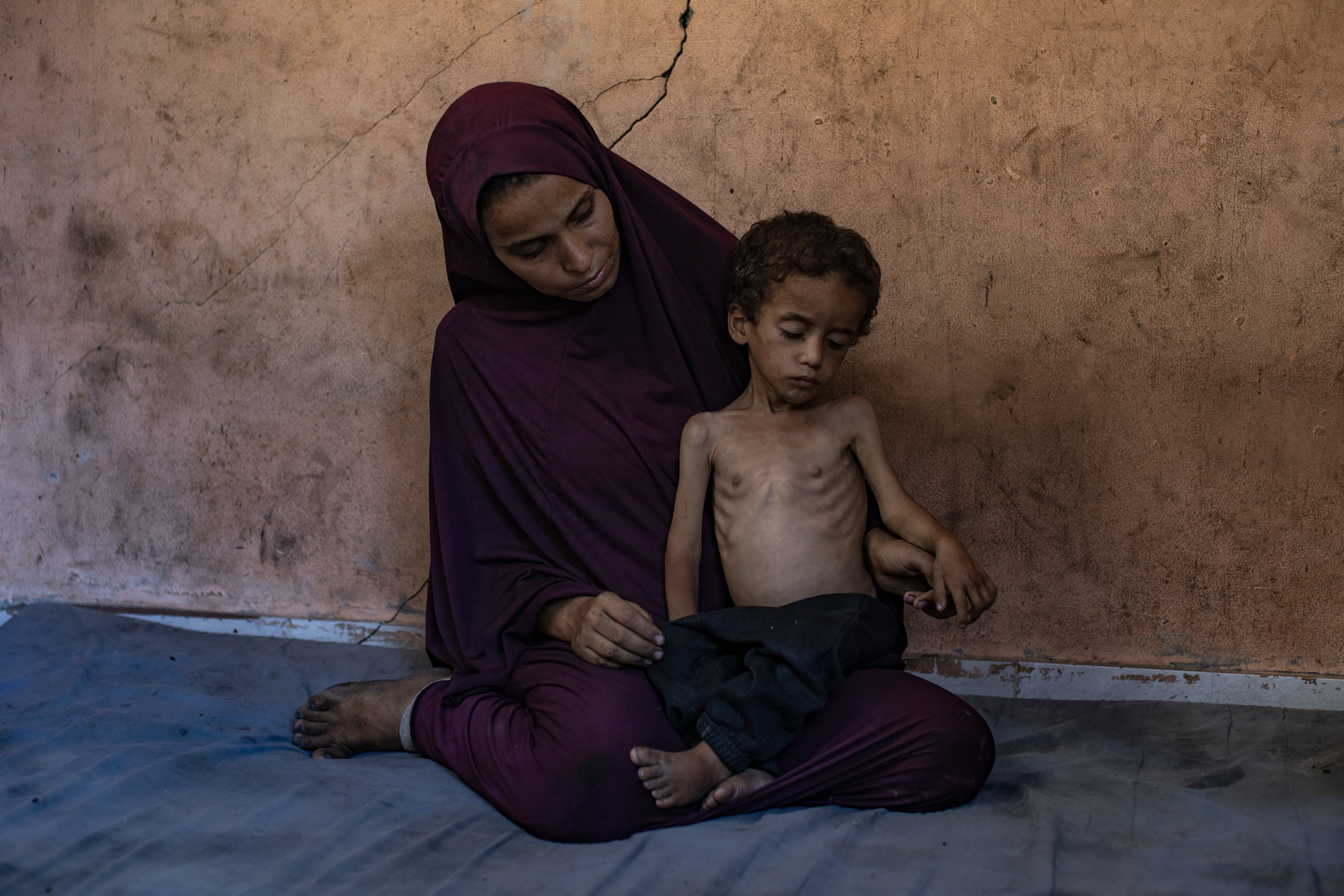 Palestinian child Yazan Abu Foul, aged two, is cared for by his mother Naima, as he suffers from severe malnutrition due to the acute shortage of food in the Gaza Strip. Photo: EPA
