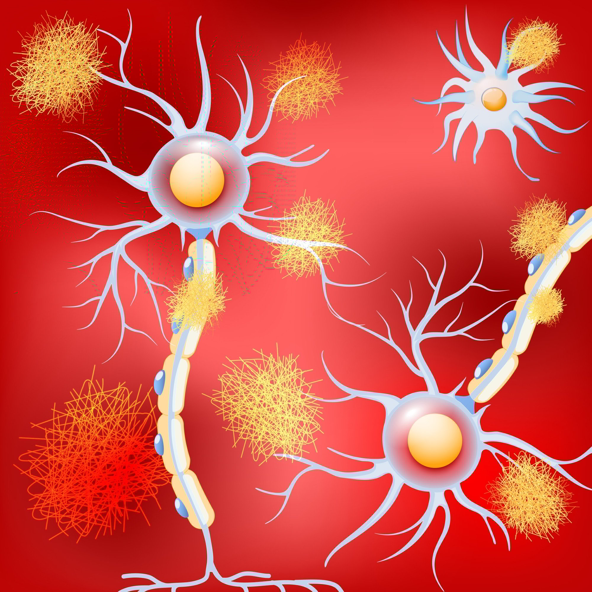 An illustration of neurons in a brain with Alzheimer's disease and amyloid plaques. Elevated brain copper levels are linked to fewer amyloid plaques and tau tangles. Photo: Shutterstock
