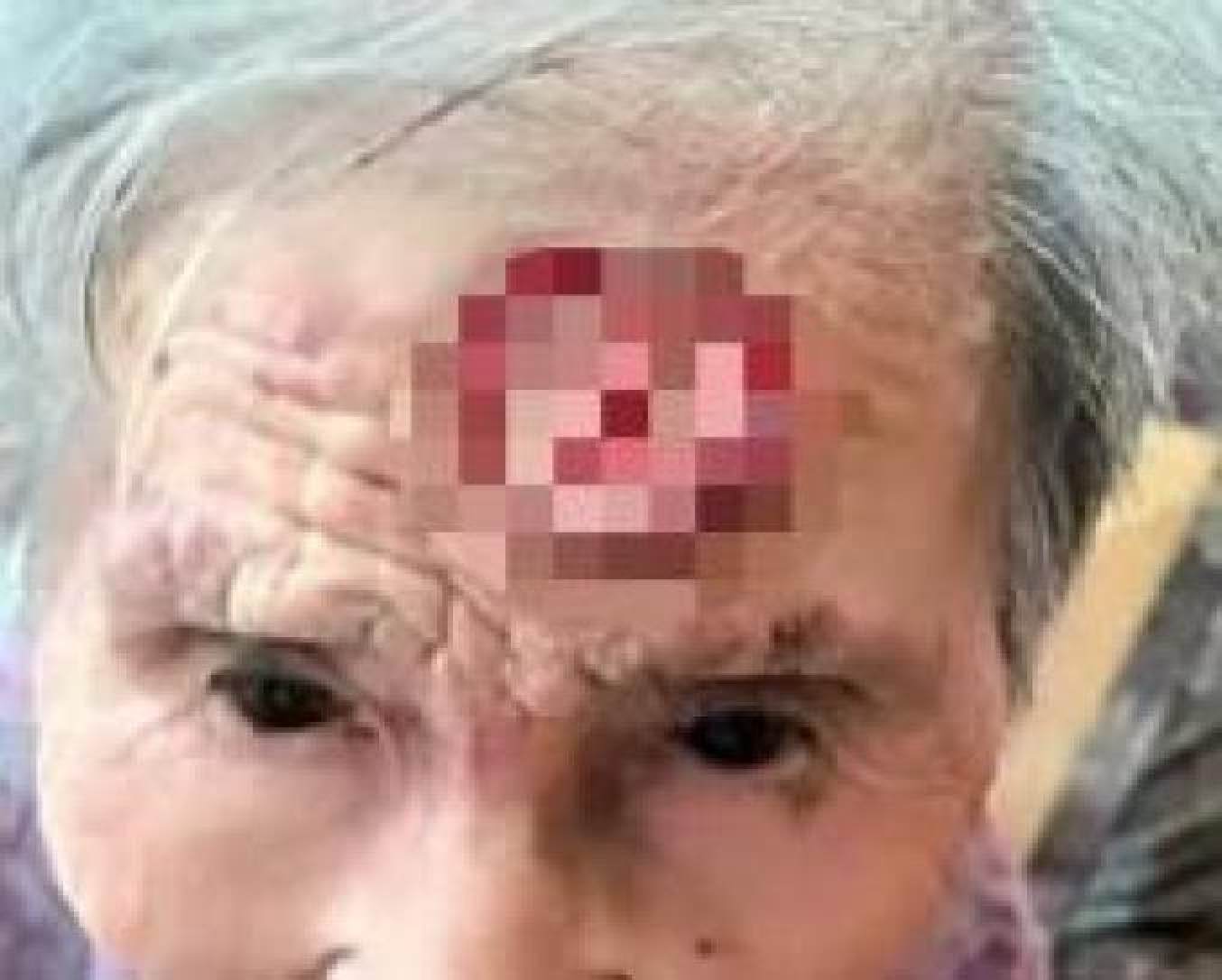 The wound caused by Gu’s self-surgery began to bleed heavily, forcing doctors to act. Photo: Handout