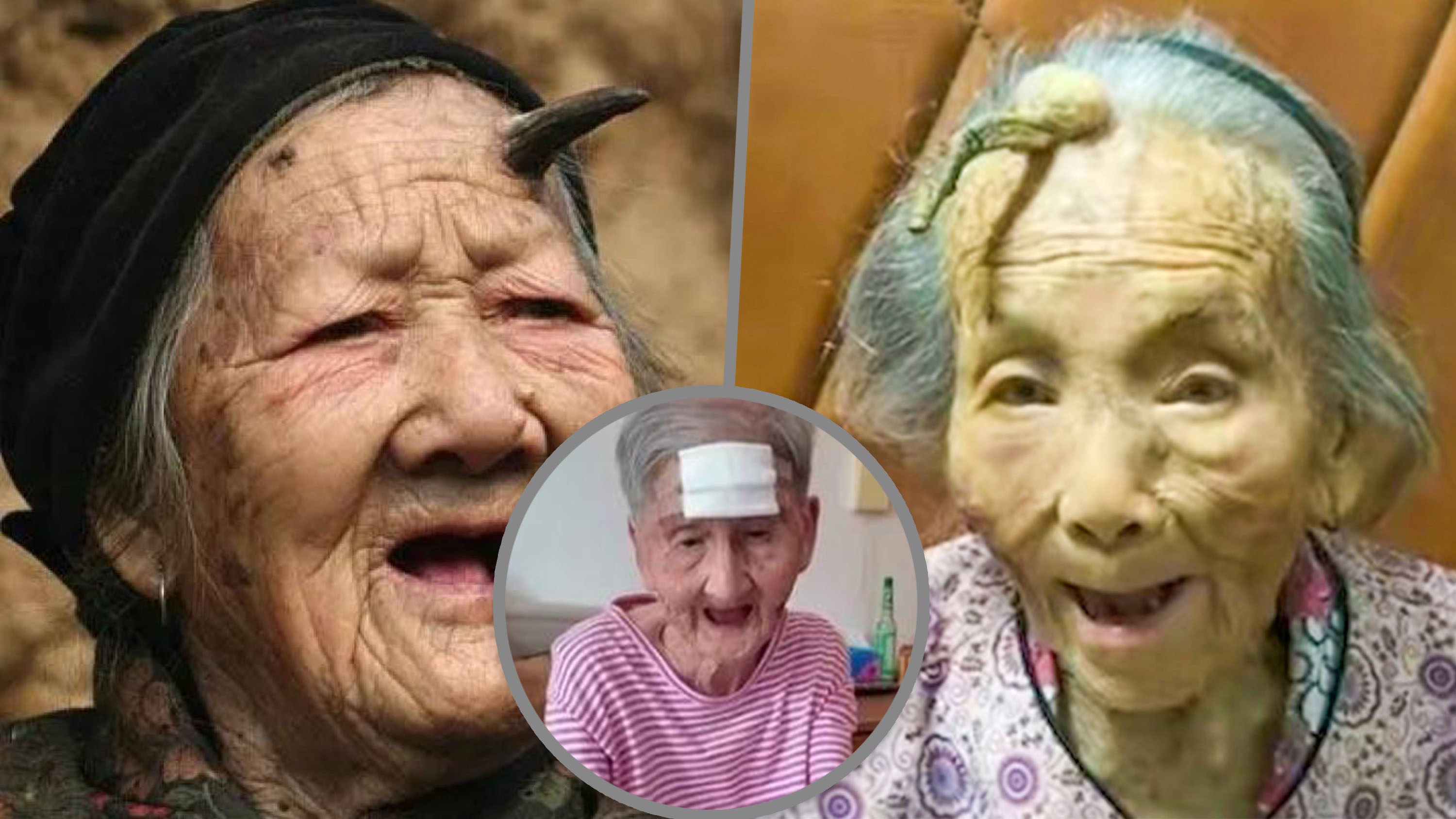 Cutaneous horns, which are horn-like growths, can develop in older adults, especially those aged between 60 and 80. However, Gu (circle photo) took the drastic step of cutting off hers with a pair of scissors. Photo: SCMP composite/QQ.com/people.com.cn/The Paper