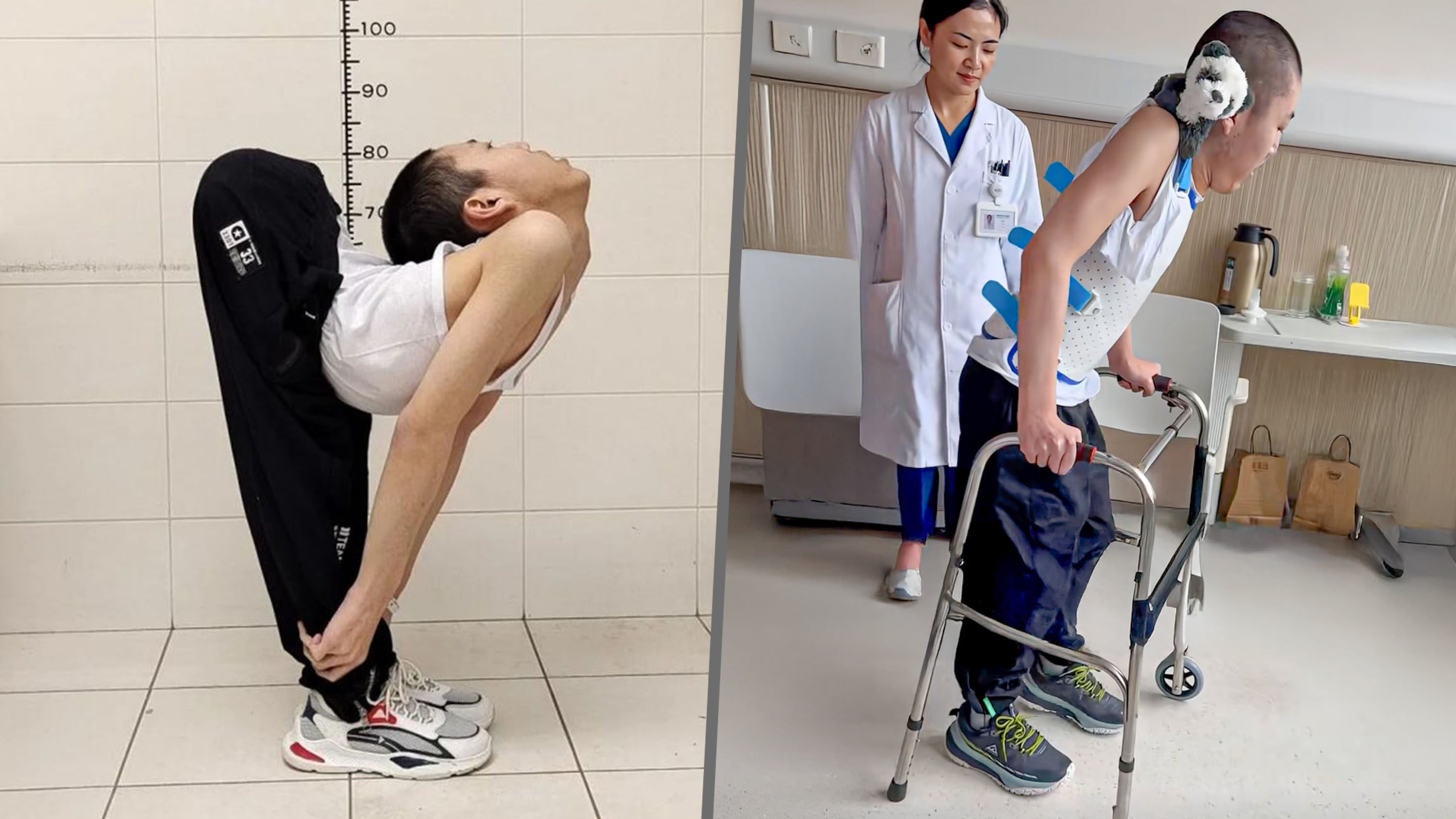 China’s so-called folded boy finally stands upright after four operations to break and reset his body. Photo: SCMP composite/Douyin